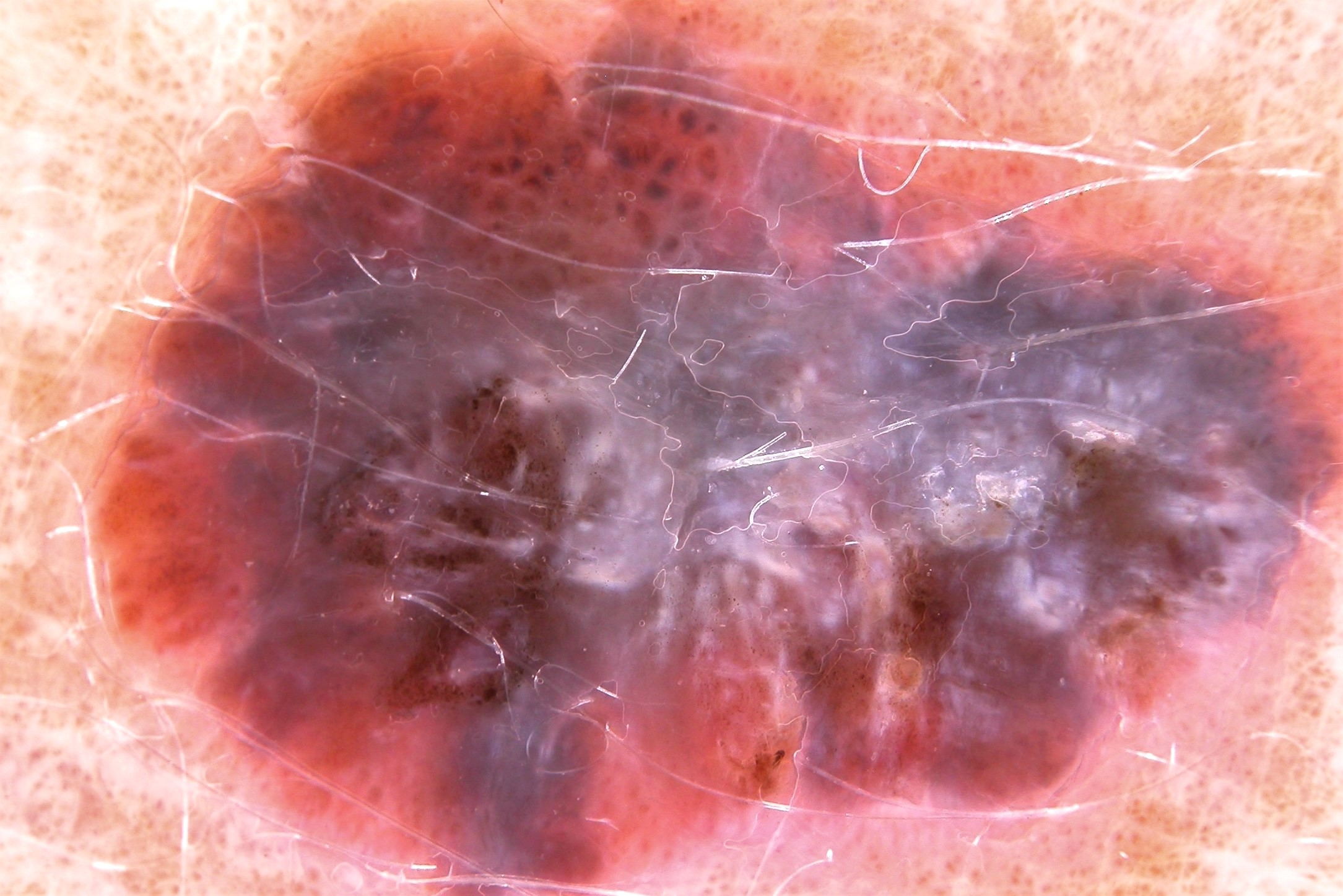 4MES, dermatoscopia; lesión asimétrica en los dos ejes (en color y estructura), puntos y globul irreg y velo azul-blanquecino area blanca cicat (3)