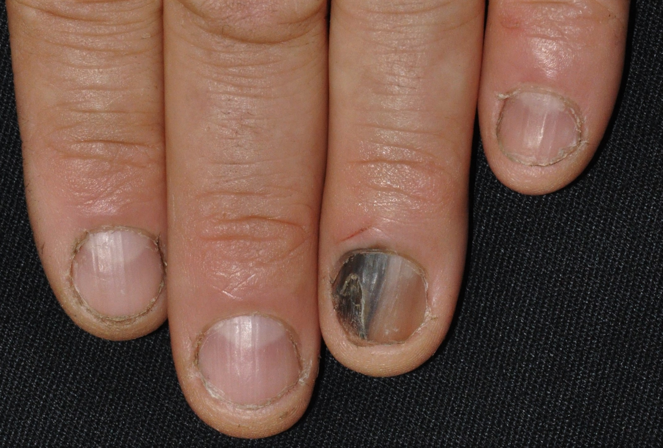 C43.9 melanoma lentiginoso acral; banda pigmentada; signo de Hutchinson;  melanoniquia estriada; 4 mm; localización bajo uña de mano; evolución 12 meses (1)