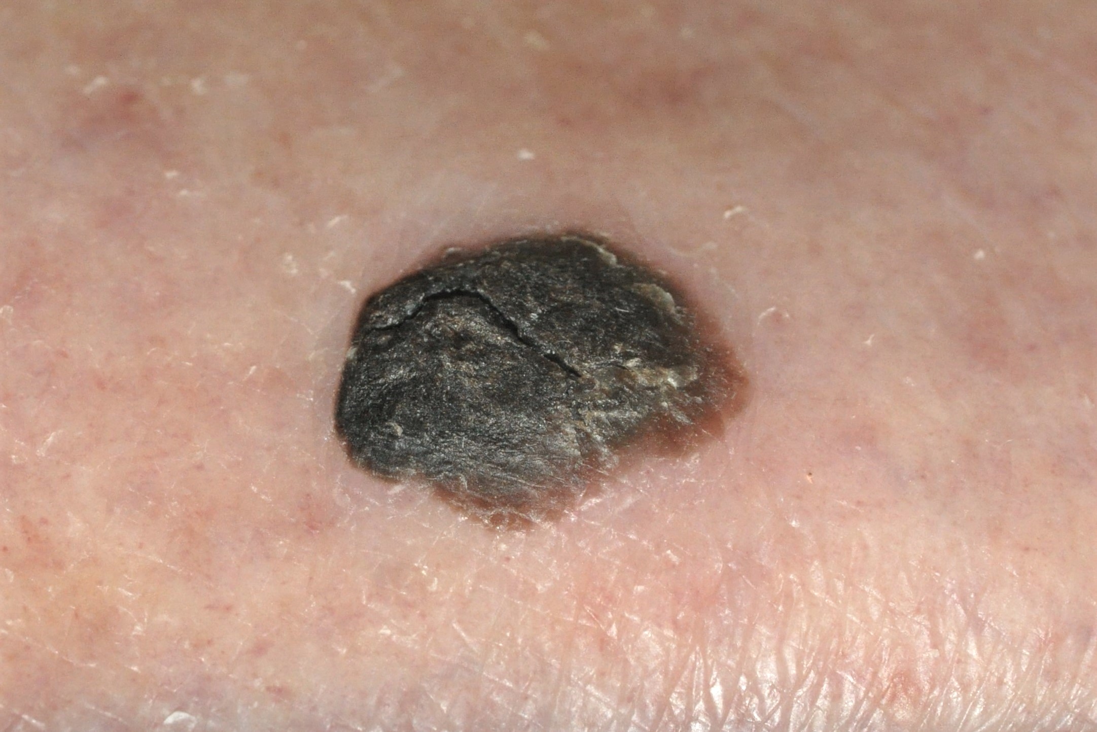 C43.9 melanoma nodular; pápulonodulo pigmentado y queratósico; tumor; 12 mm; localización espalda; evolución indeterminada