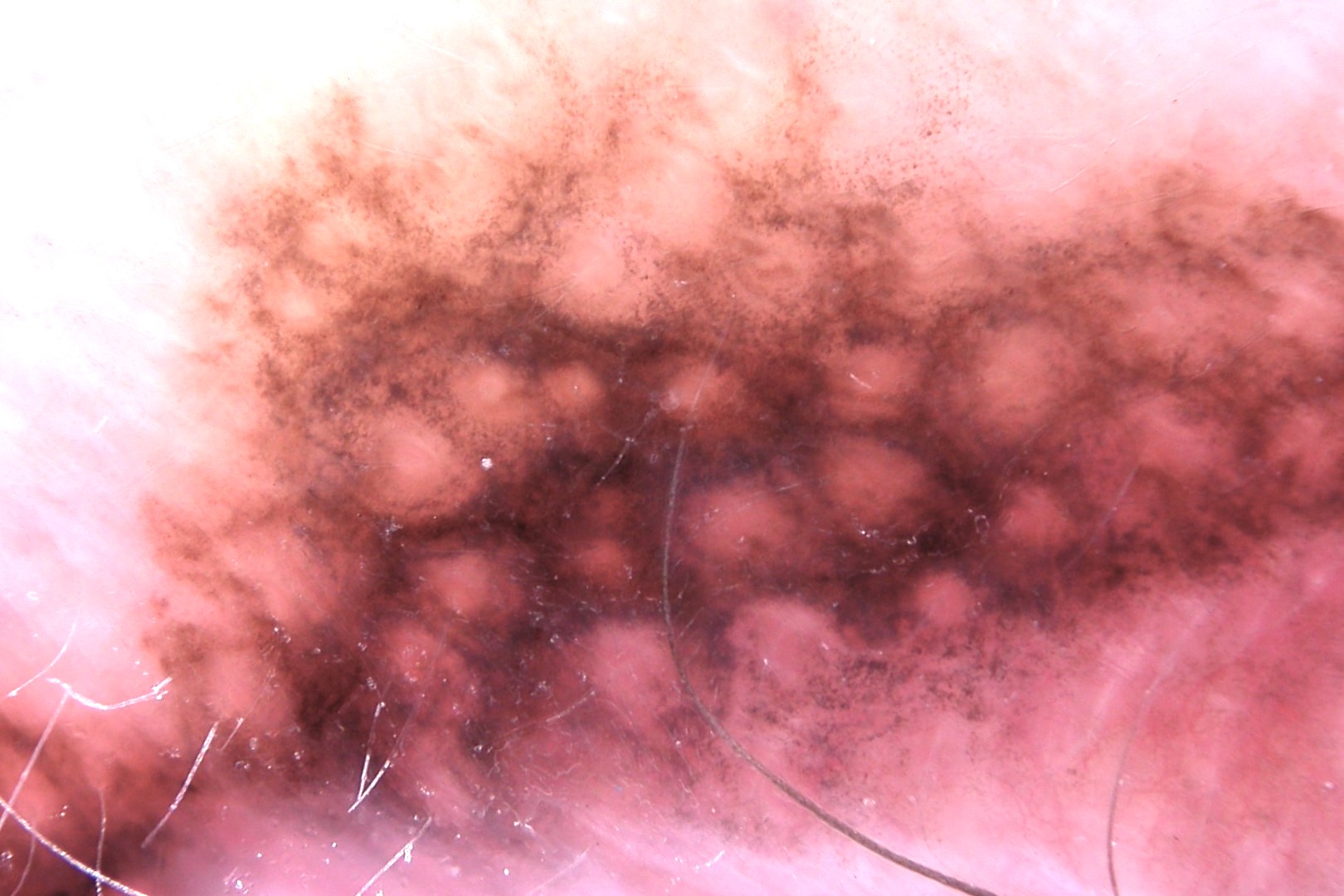 Dermatoscopia LM, detalle; pseudoretículo pigmentado con orificios foliculares de diferente tamaño, puntos gris-pizarra en periferia
