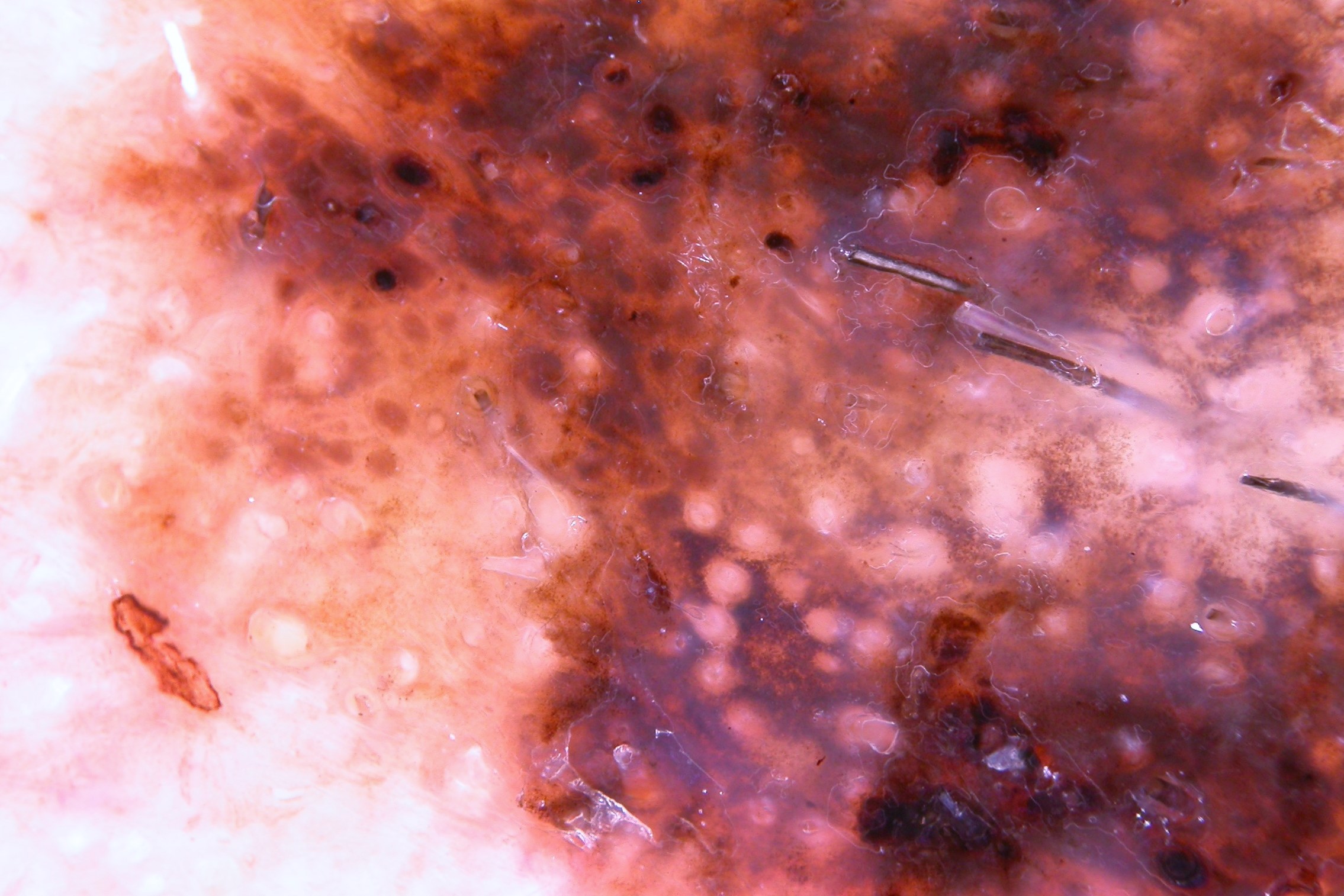 Dermatoscopia LM; pseudoretículo pigmentado con obliteración parcial o total de los orificios foliculares, puntos y glóbulos marrones y azul-gris irregulares, vel