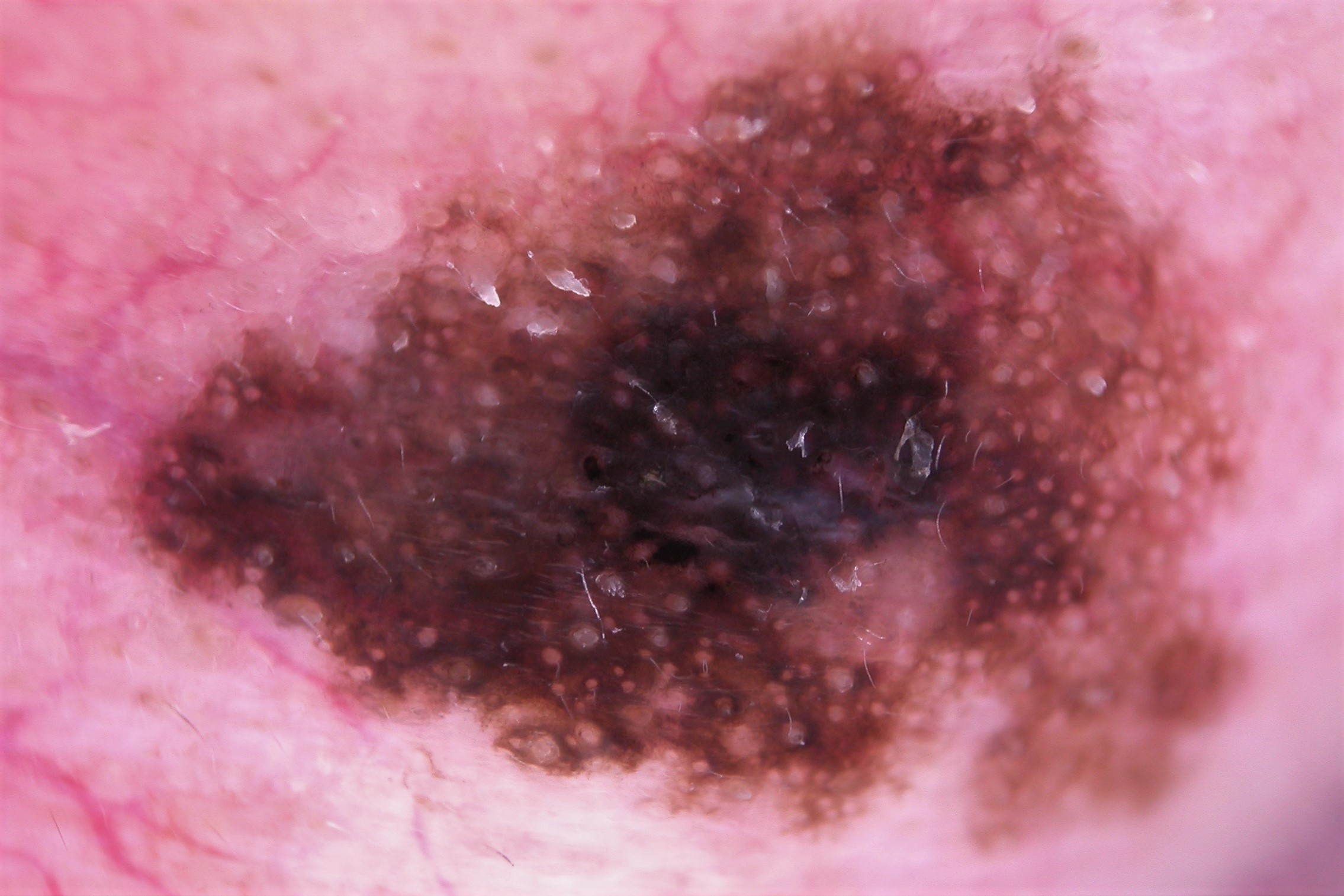 Dermatoscopia LM; pseudoretículo pigmentado con orificios foliculares de difernte tamaño y obliteración parcial o total de los mismoa, velo azul-blaquecino