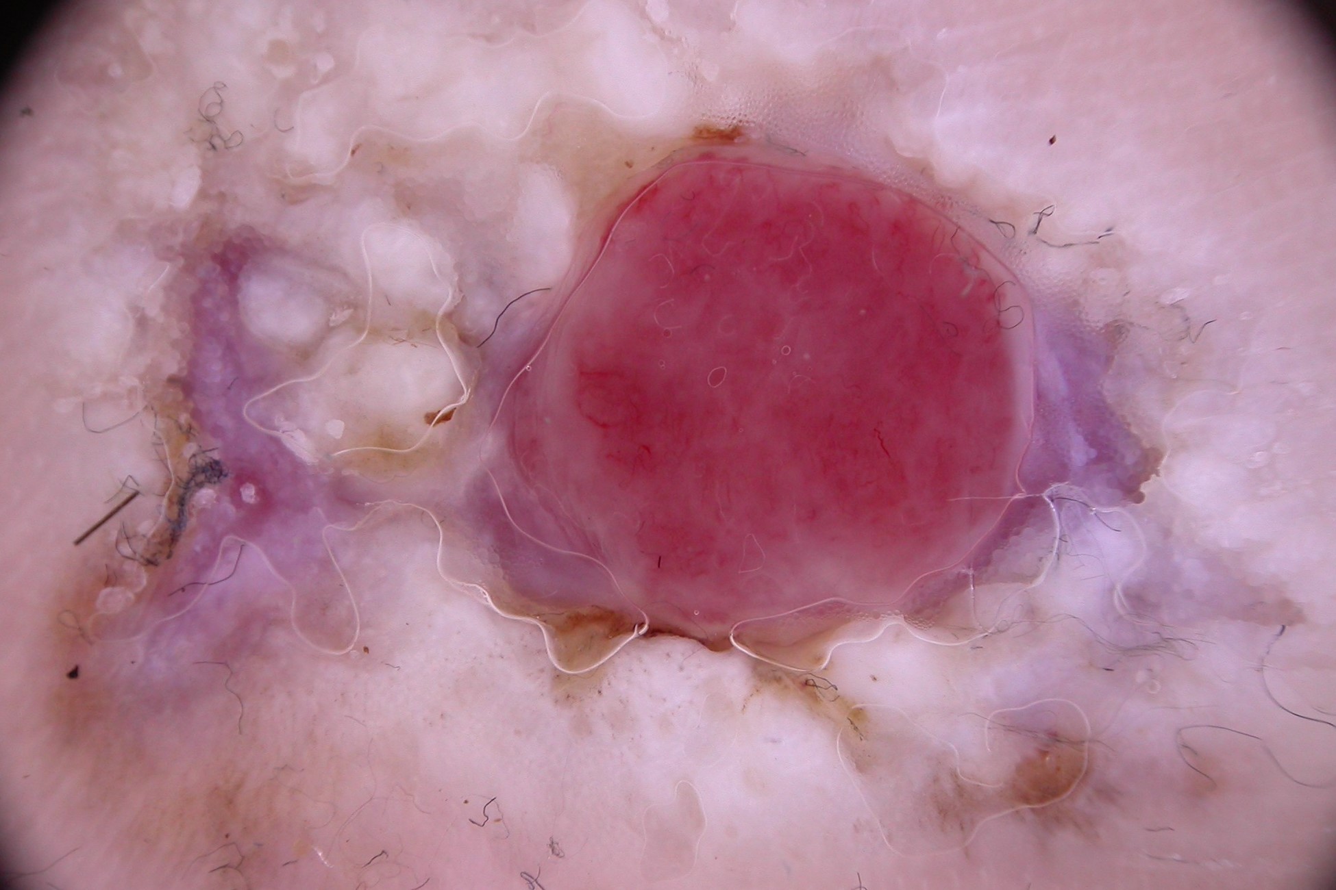 Dermatoscopia MLA; área gris-azulada puntos y glóbulos irregulares en periferia