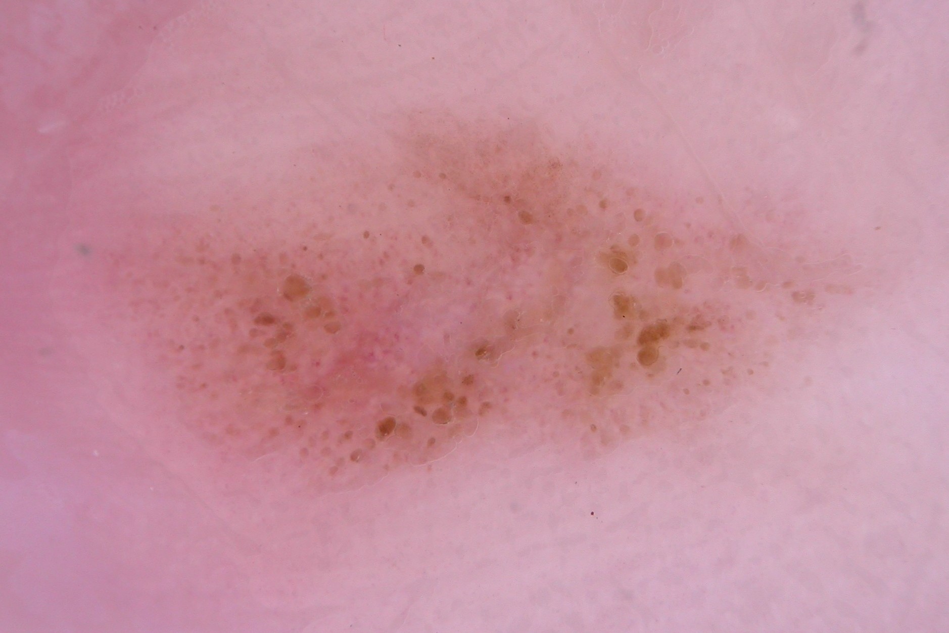 Dermatoscopia MLA; puntos y glóbulos irregulares y área rojo-lechosa central