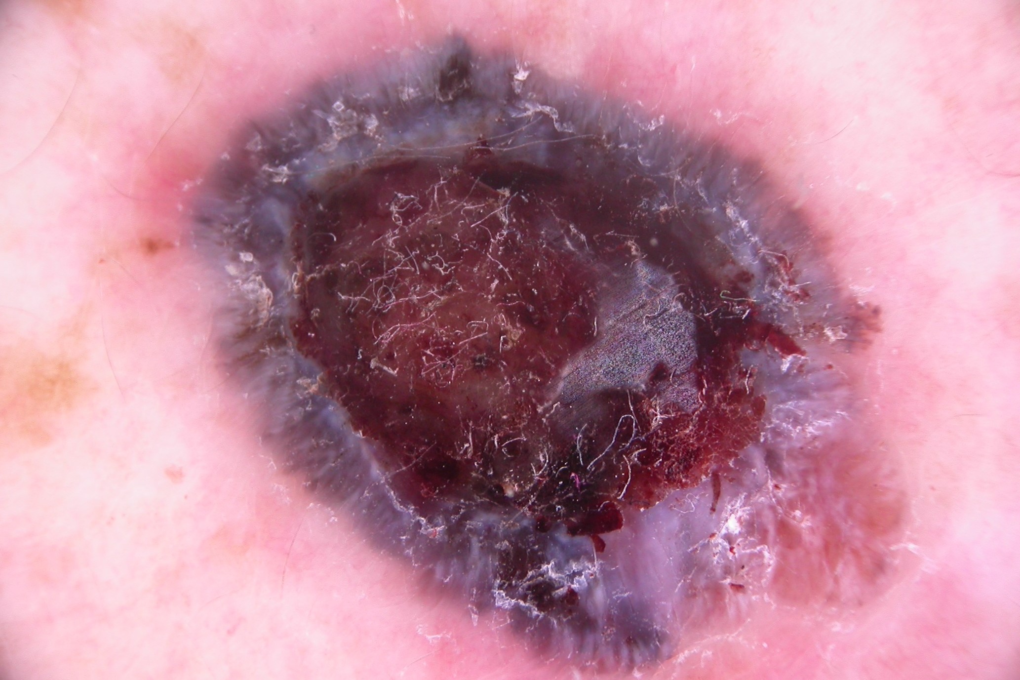 Dermatoscopia del MN; lesión simétrica de color negroazulado, velo azul-blanquedino, crisálidas, patrón vascular polimorfo