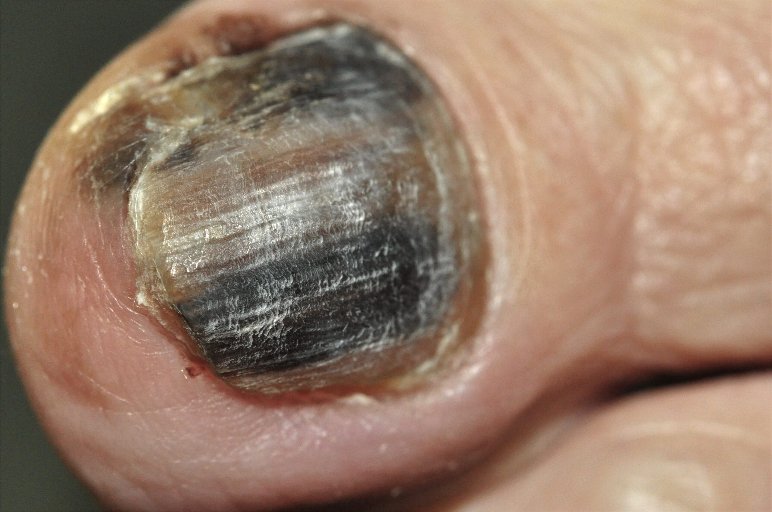MLA (melanoma subungueal ) C43.92; banda de melanoniquia longitudinal de 2 años de evolución, de color negro uniforme, 50% signo de Hut (3)