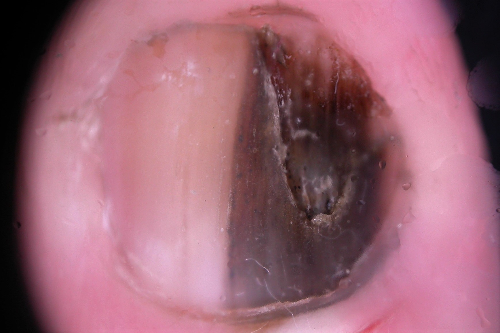 MSU dermatoscopia, banda de melanoniquia longitudinal que ocupa el 50% de la superficie unguel, que destruye a tabla unqueal y la desborda