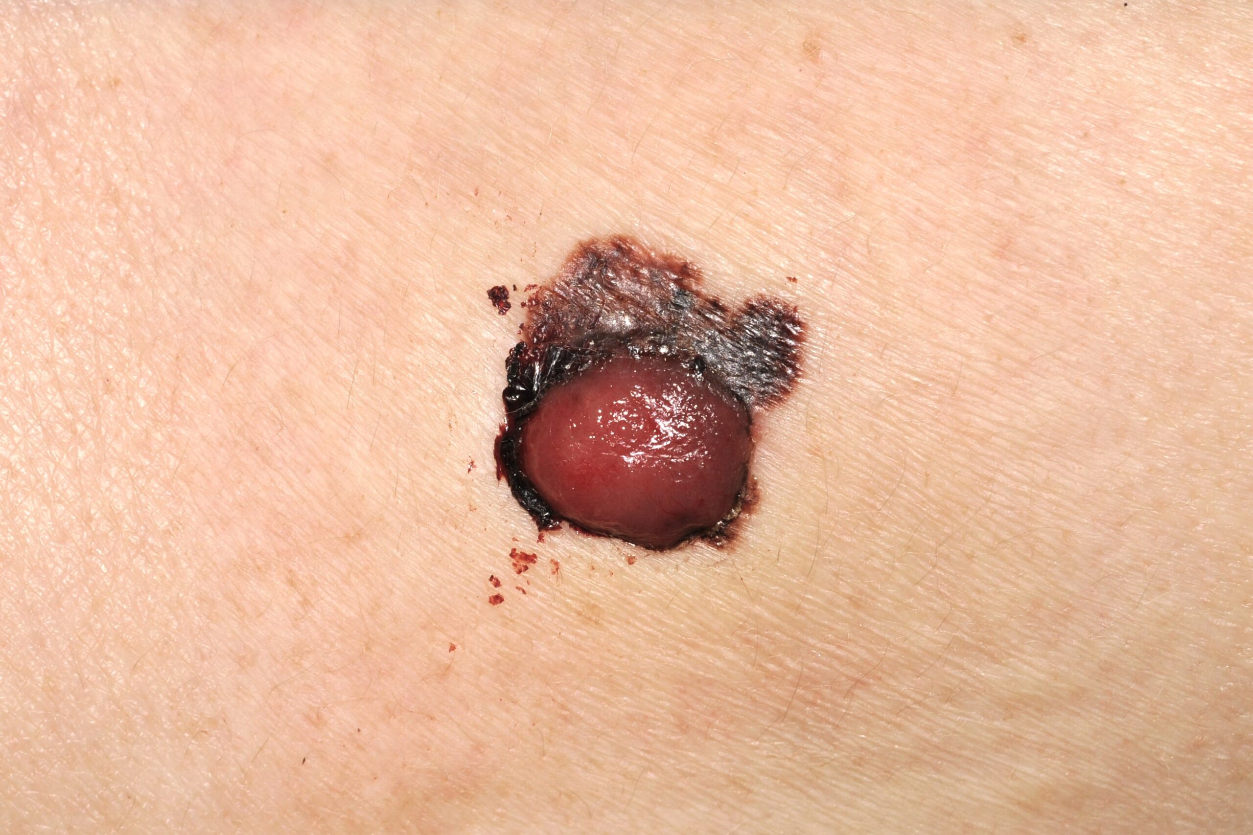 Melanoma de extension superficial fase de crecimiento vertical C43.91; placa que ocupa la mayor parte de una mácula policroma en la base. 7x10 mm (2)