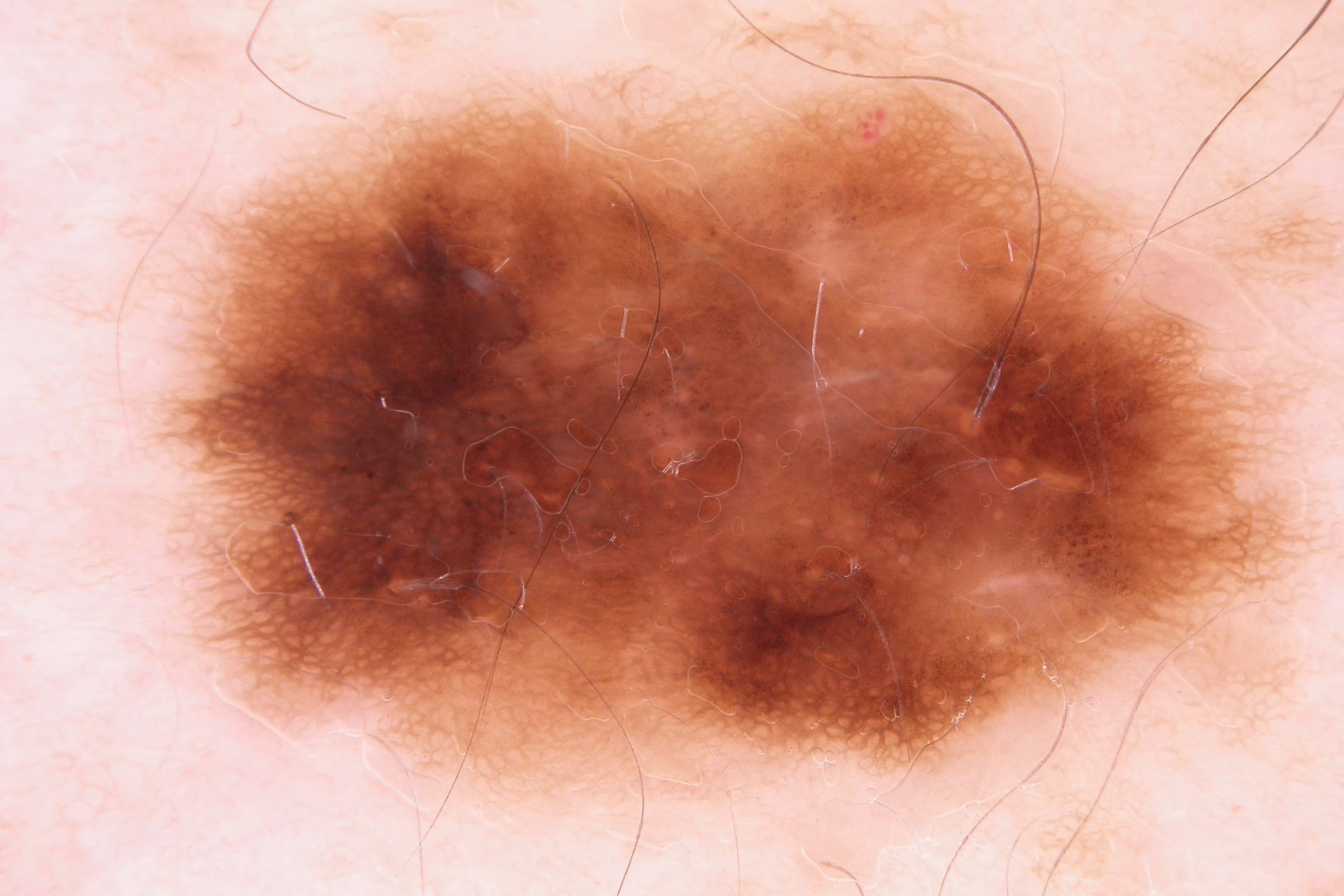 NCA dermatocopia; lesión asimétrica (en color y en estructuras), con áreas de hiperpigmentación e hipopigmentción parcheada y áreas de retículo atípico (1)