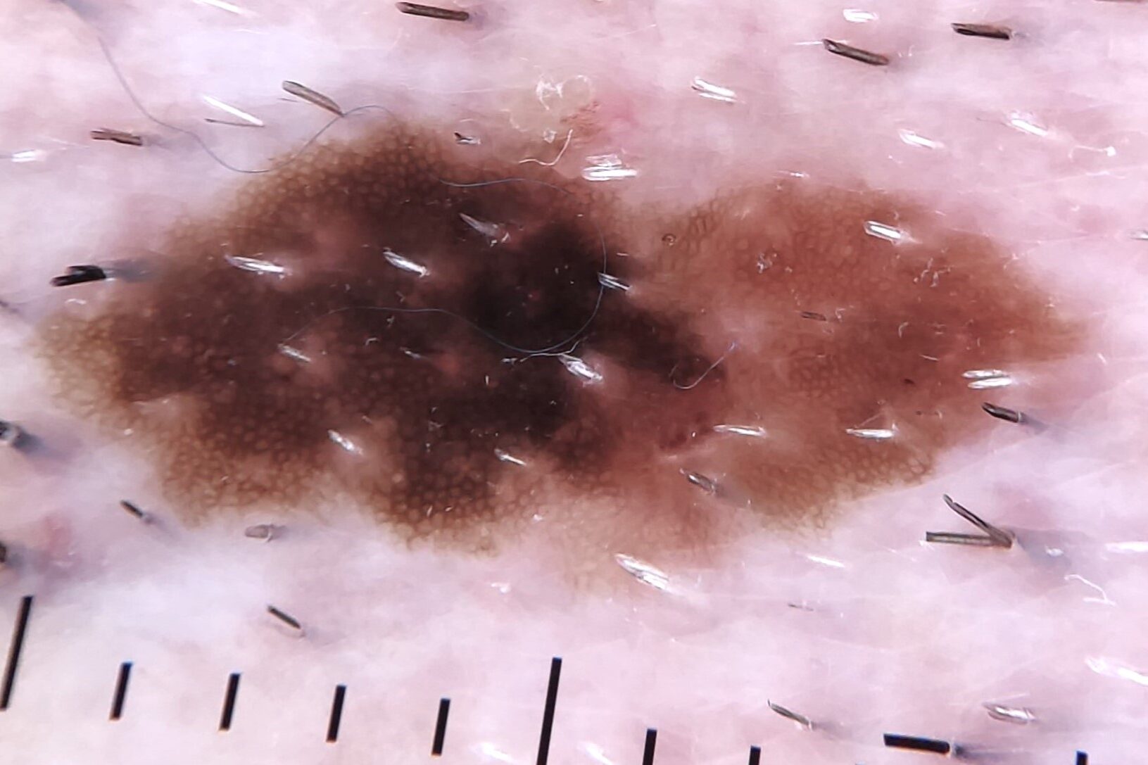 NCA dermatocopia; lesión asimétrica en el eje vertical (en color y en estructuras), con áreas de hiperpigmentación parcheada y retículo atípico