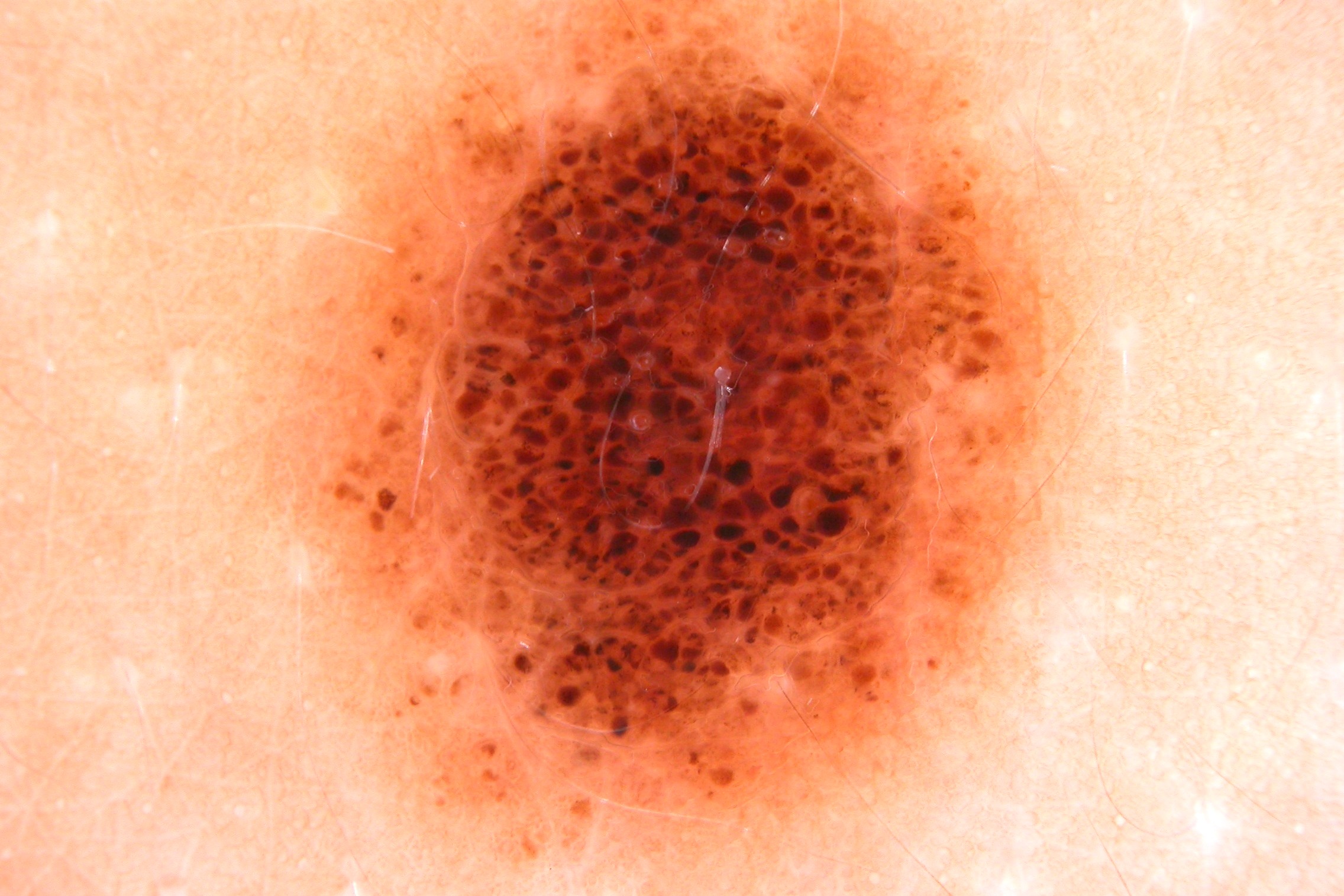 NMCA compuesto, dermatoscopia; patrón globular con presencia de glóbulos en periferia (lesión en crecimiento) (1)