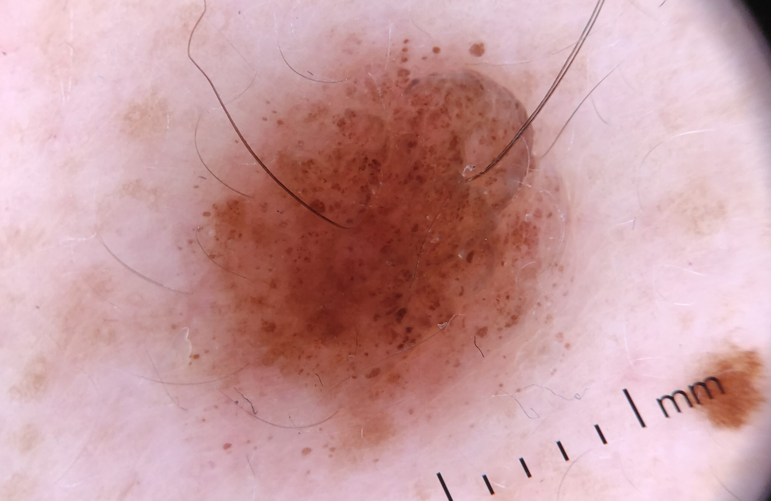 NMCA compuesto, dermatoscopia, patrón globular