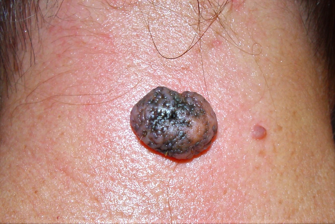 NMCA intradérmico D22; papulonódulo  pigmentado, de superficie papilomatosa y bordes regulares, de 17 mm, en nuca