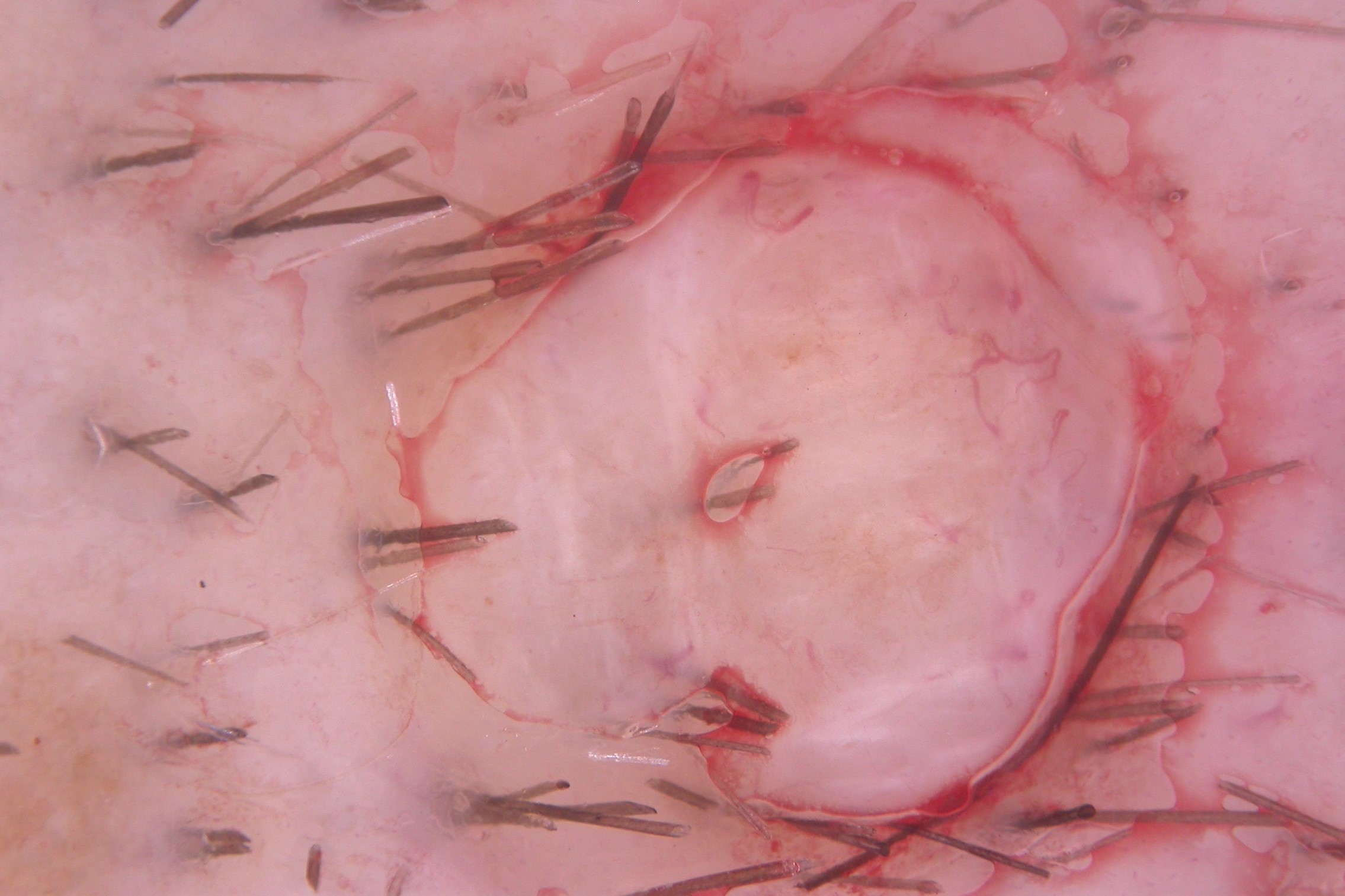 NMCA intradérmico, dermatoscopia; ausencia de pigmento, areas blancas de fibrosis y telangiectasias ramificadas