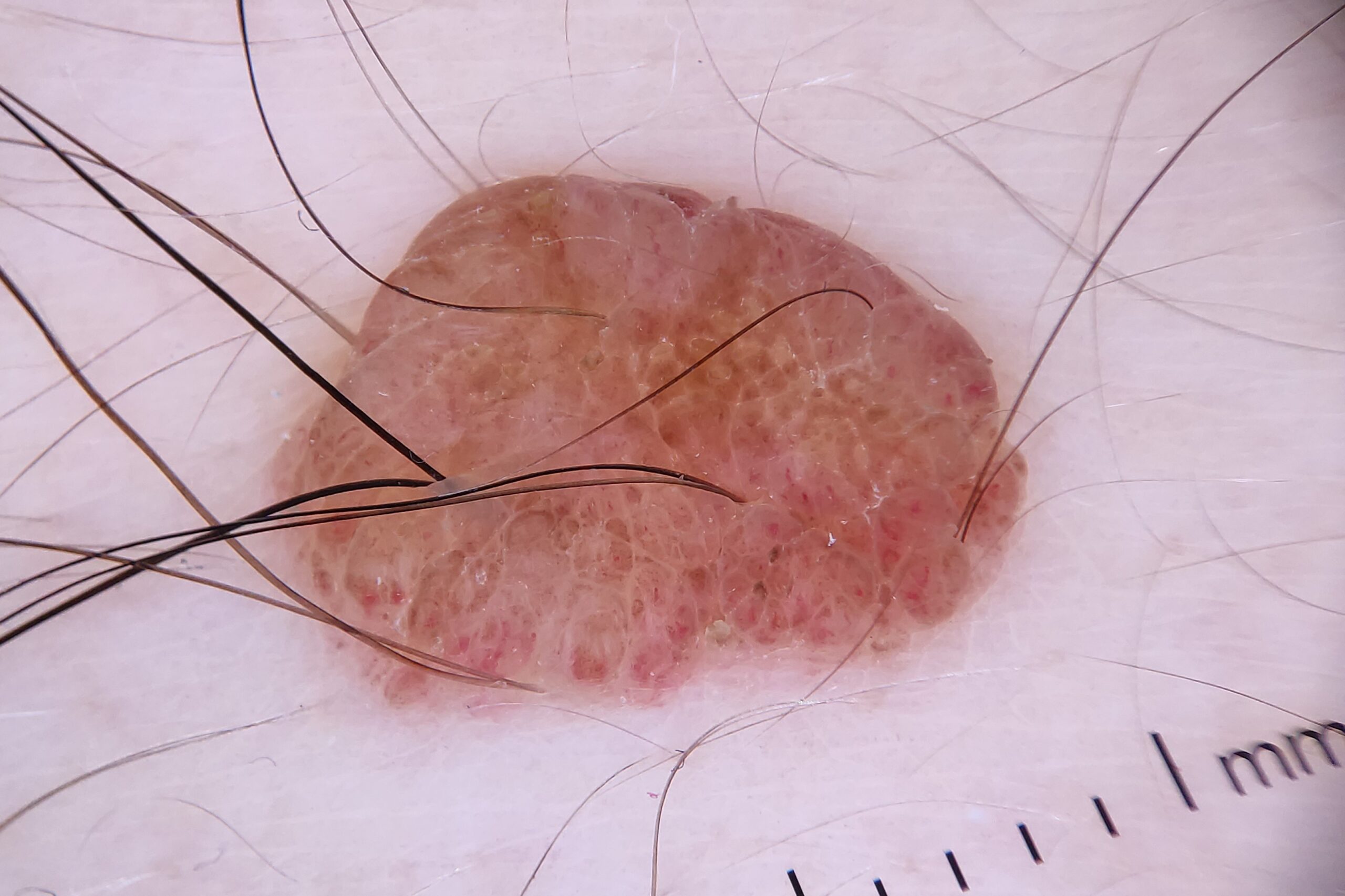 NMCA intradérmico, dermatoscopia; patrón en empedrado y vasos en coma
