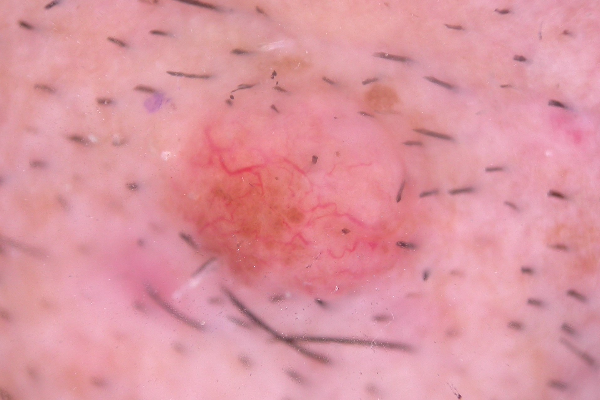 NMCA intradérmico, dermatoscopia; trazas residuales de pigmento y telangiectasias no tan bien definidas como en el carcinoma basocelular  (1)
