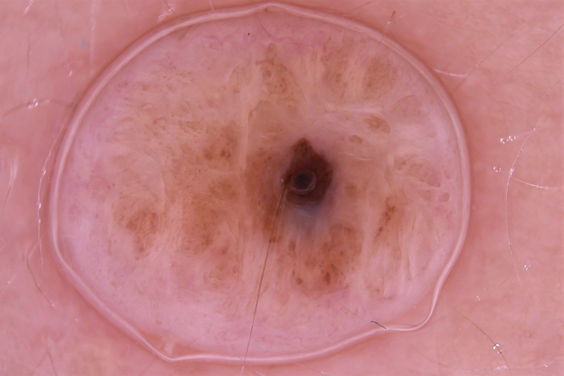 NMCA intradérmico, dermatoscopia; trazas residuales de pigmento y telangiectasias no tan bien definidas como en el carcinoma basocelular (2)