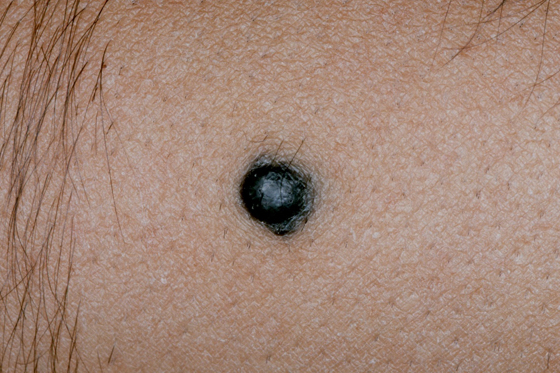 Nevus azul D20; papula de color azul plomo uniforme, de asiento dérmico, de 4 mm, estable desde hace años en el antebrazo1 (1)
