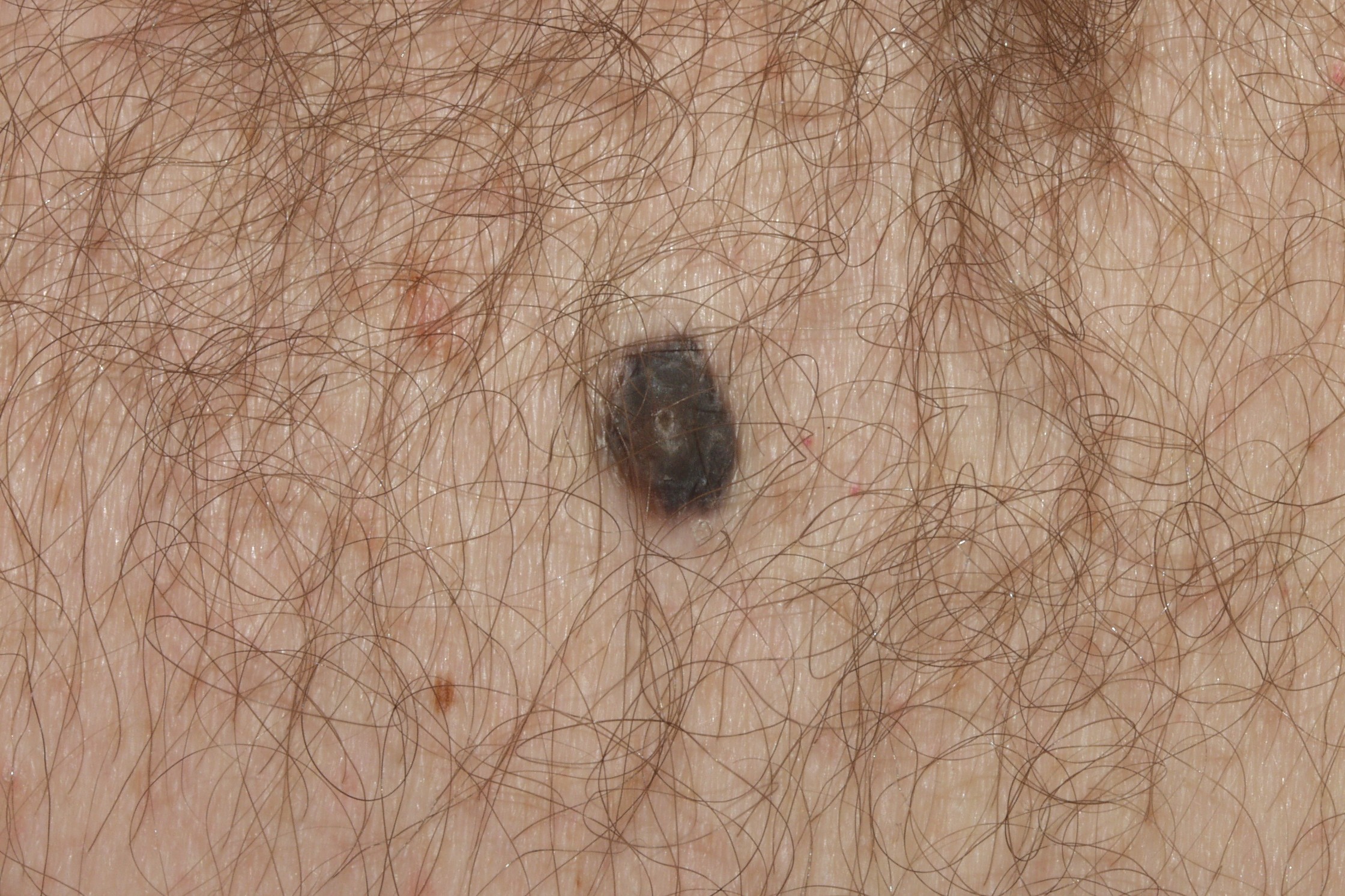 Nevus azul D20; papula de color negro-azulado uniforme, de bordes regulares, de 4 mm, estable desde hace años en cara anterior de tórax (1)