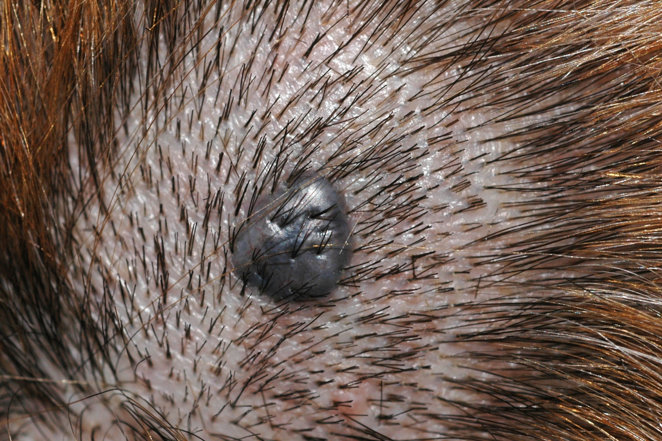 Nevus azul D20; papula de color negro-azulado uniforme, de bordes regulares, de 4 mm, estable desde hace años en cuero cabelludo (1)