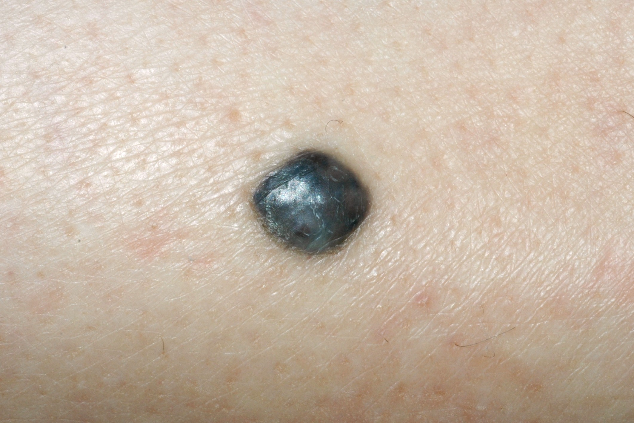 Nevus azul D20; papula de color negro-azulado uniforme, de bordes regulares, de 5 mm, estable desde hace años en antebrazo dcho