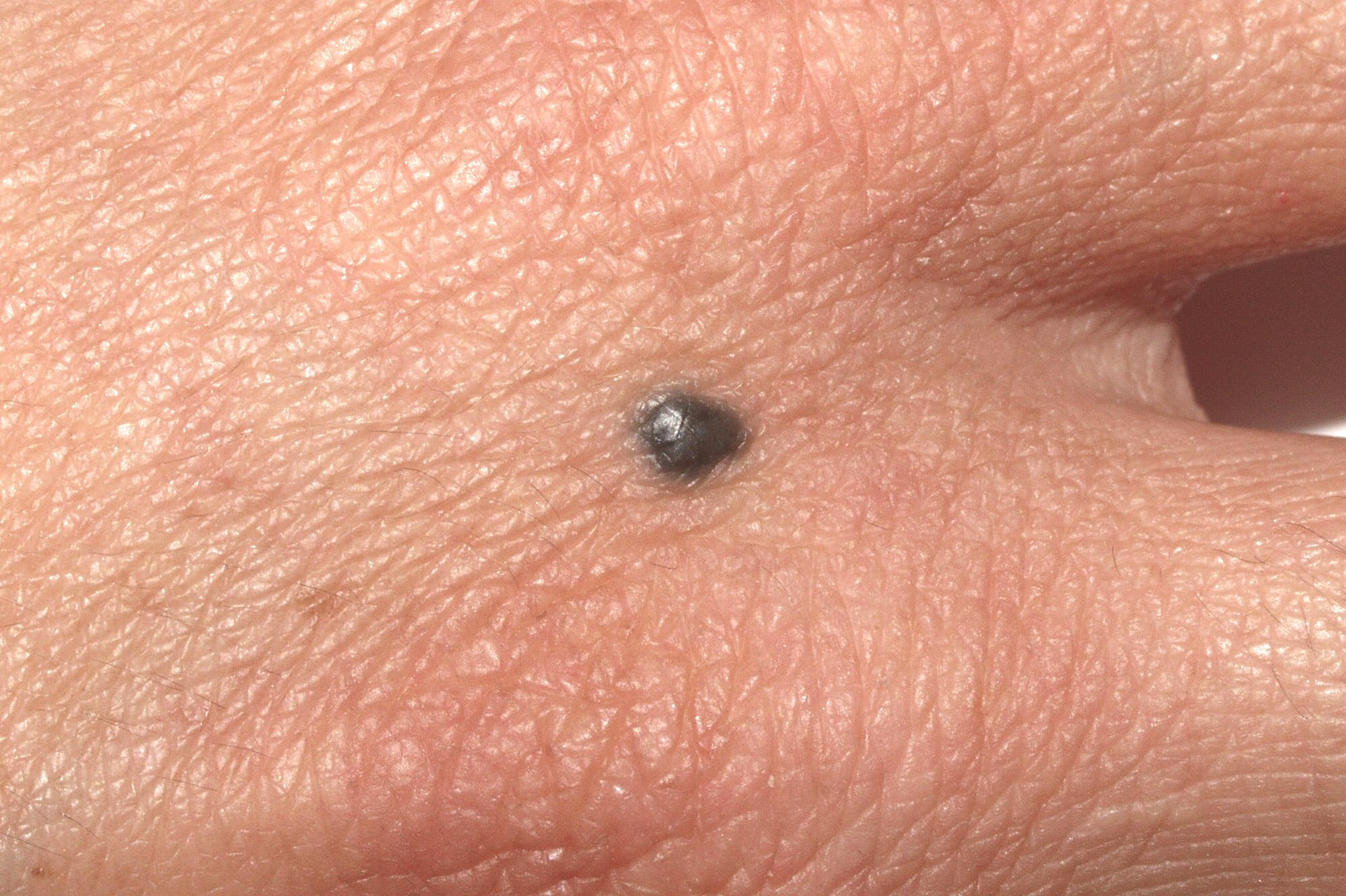 Nevus azul D20; papula de color negro-azulado uniforme, de bordes regulares, indurada, que mide 3 mm. Se mantiene estable desde hace años en dorso de mano