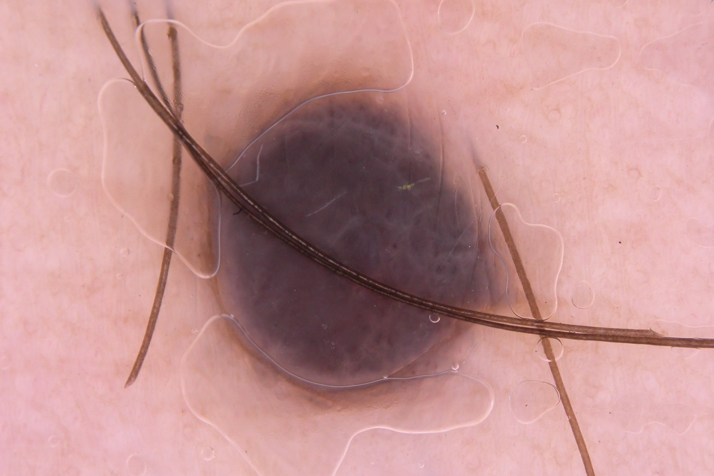 Nevus azul, dermatoscopia; área de color azul uniforme sin estructuras (3)