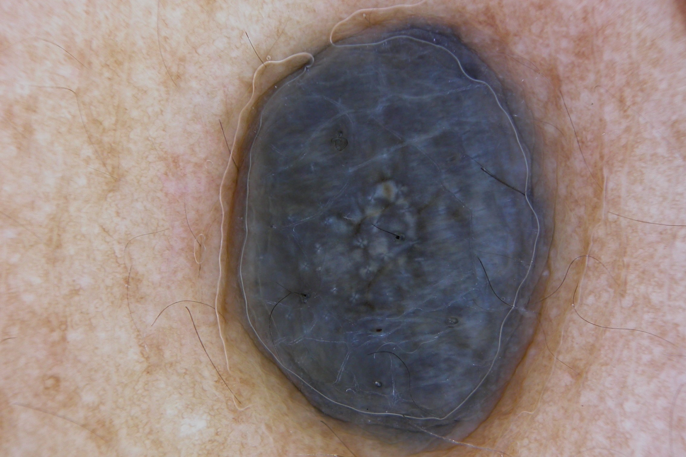Nevus blau, dermatoscopia; área de color azul uniforme sin estructuras (1)