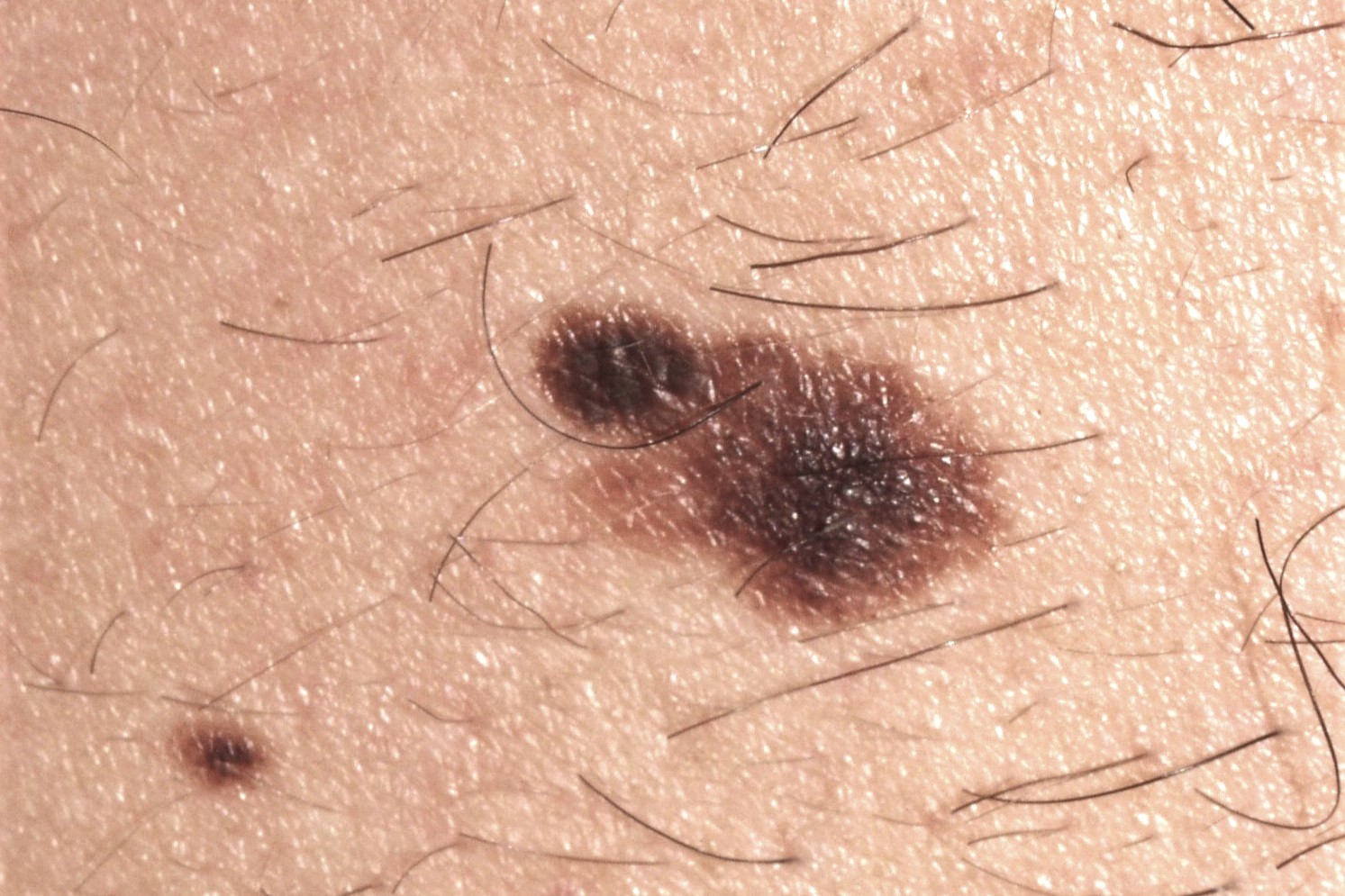 Nevus cínicamente atípico D22; tumor pigmentado, bicolor, de bordes irregulares y de 8 mm de diámetro; localización abdomen. Estable en el último año (1)