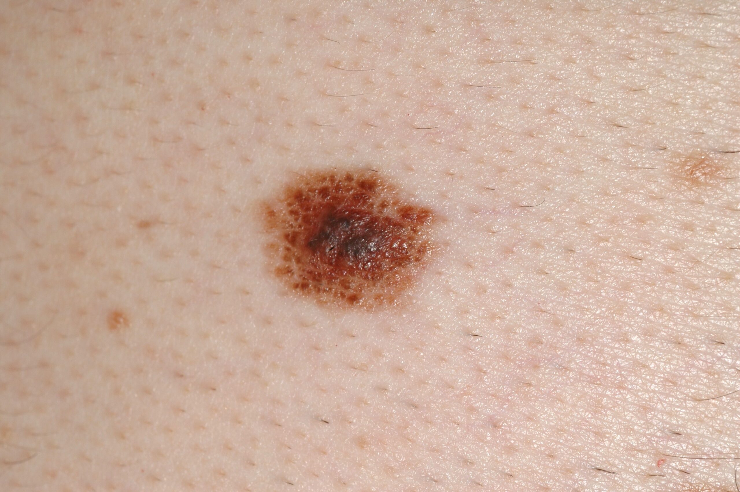 Nevus cínicamente atípico D22; tumor pigmentado, bicolor, de bordes irregulares y de 8 mm de diámetro; localización abdomen. Estable en el último año (4)