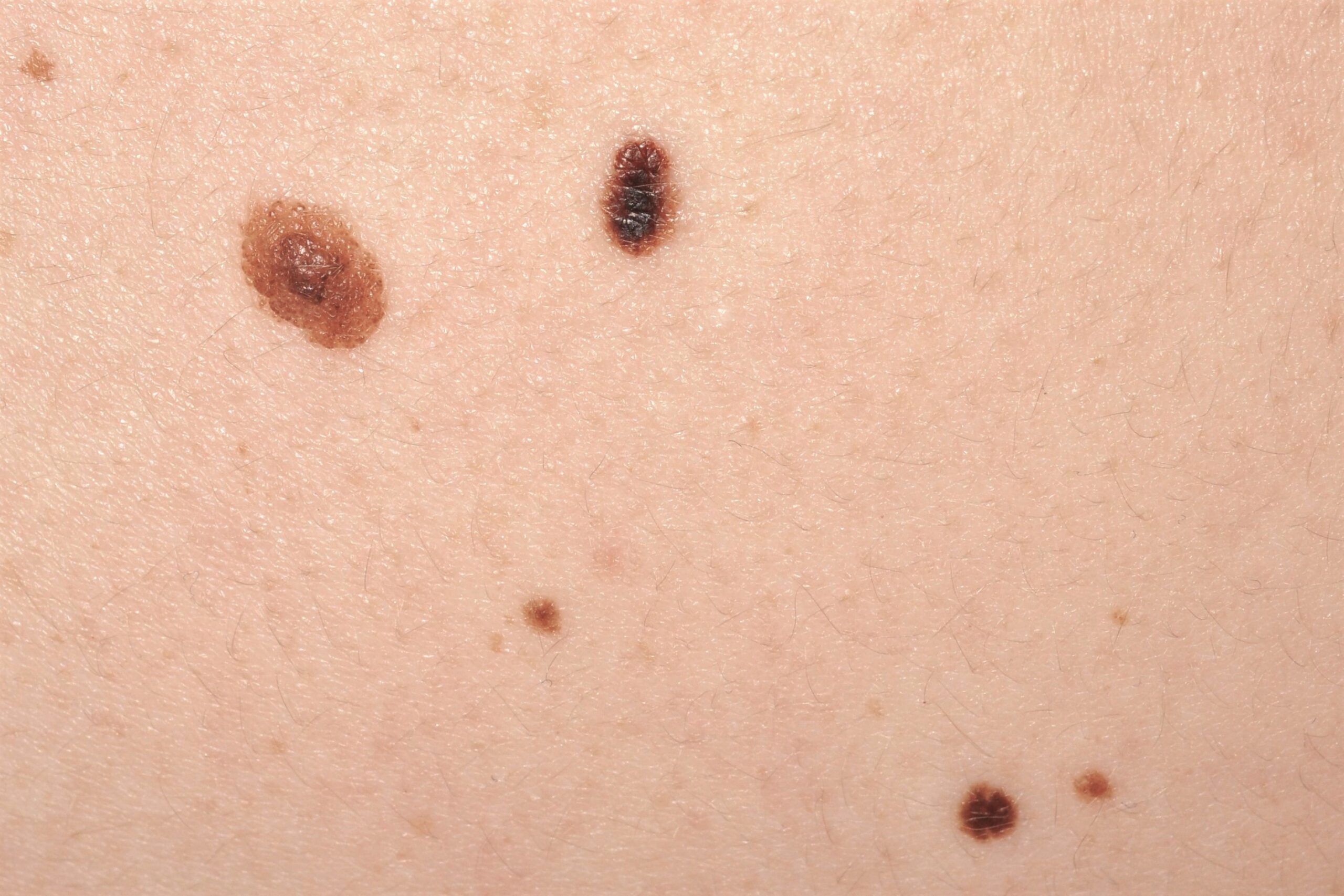 Nevus cínicamente atípicos D22; variante en huevo frito (superior izquierdo) y lentiginoso (superior  central)