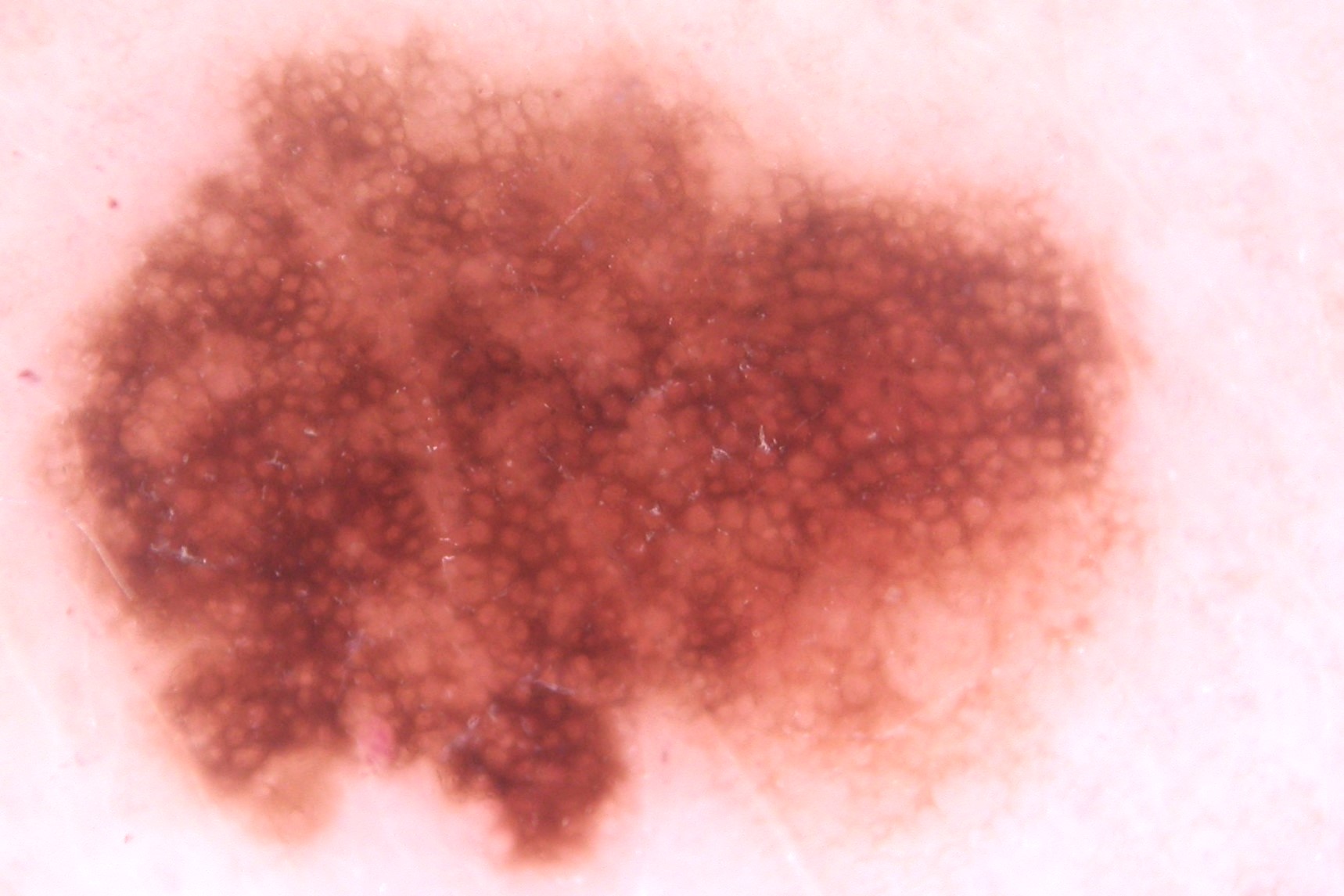 Nevus clínicamente atípico, dermatocopia; lesión asimétrica en el eje vertical (en color y en estructuras), y áreas de retículo atípico