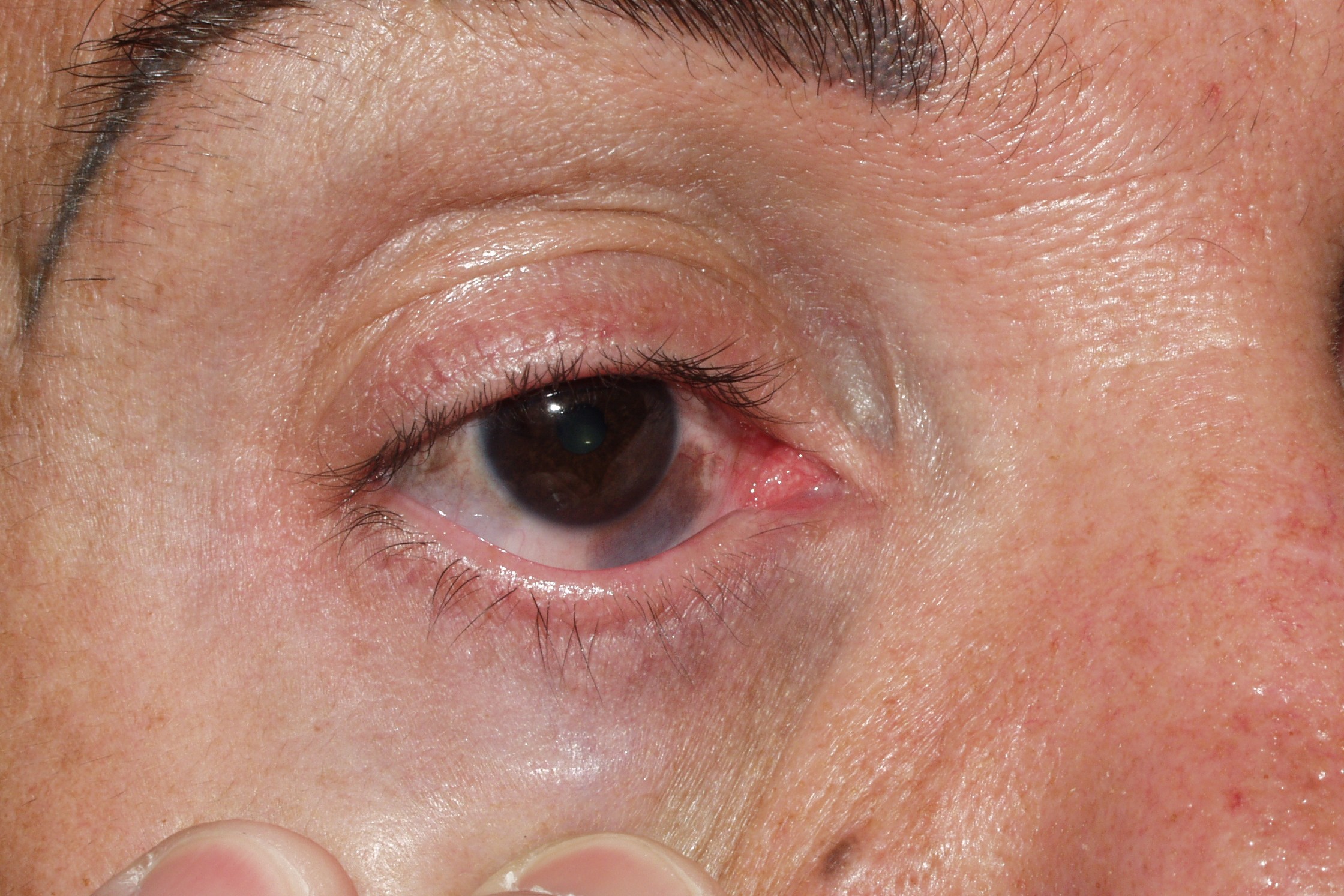 Nevus de Ota; pigmentación congénita azul-grisácea palpebral y de la esclera (1)