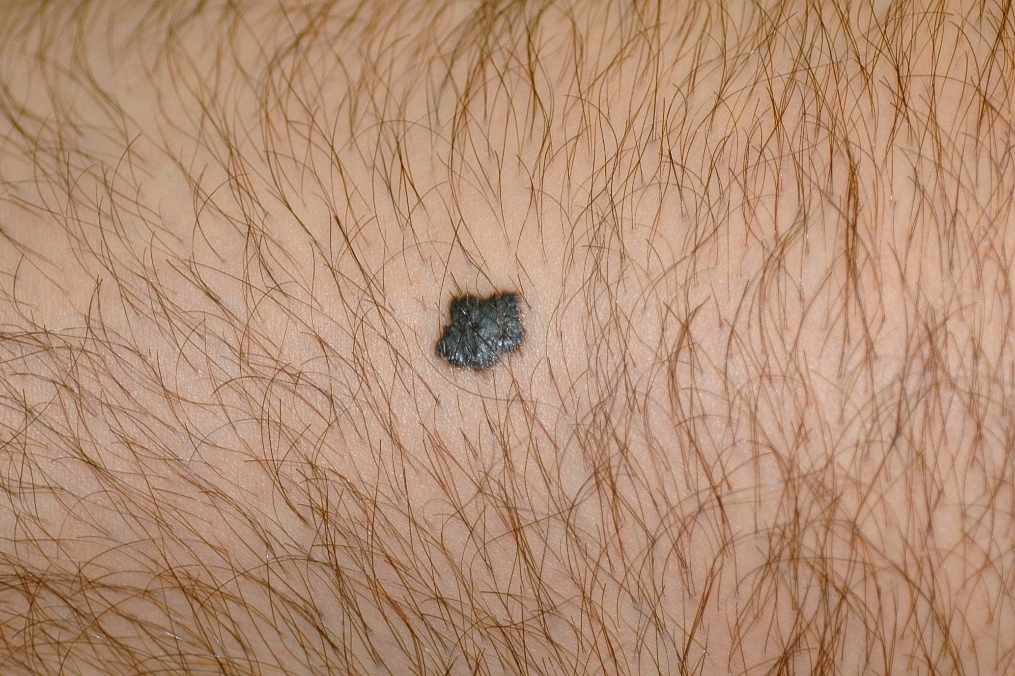 Nevus de Reed D20; pápula pigmentada de color negro, en el muslo de un varón, que se ha desarrollado en el último año. Mide 9 mm (1)