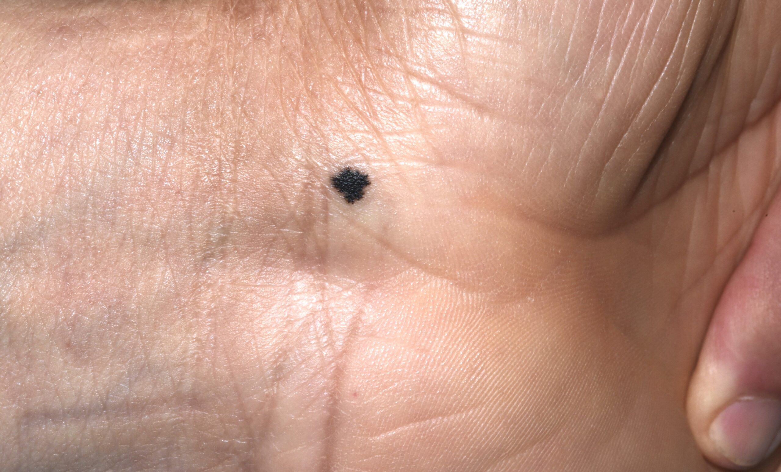 Nevus de Reed D20; pápula pigmentada de color negro, en el muslo de un varón, que se ha desarrollado en el último año. Mide 9 mm (3)