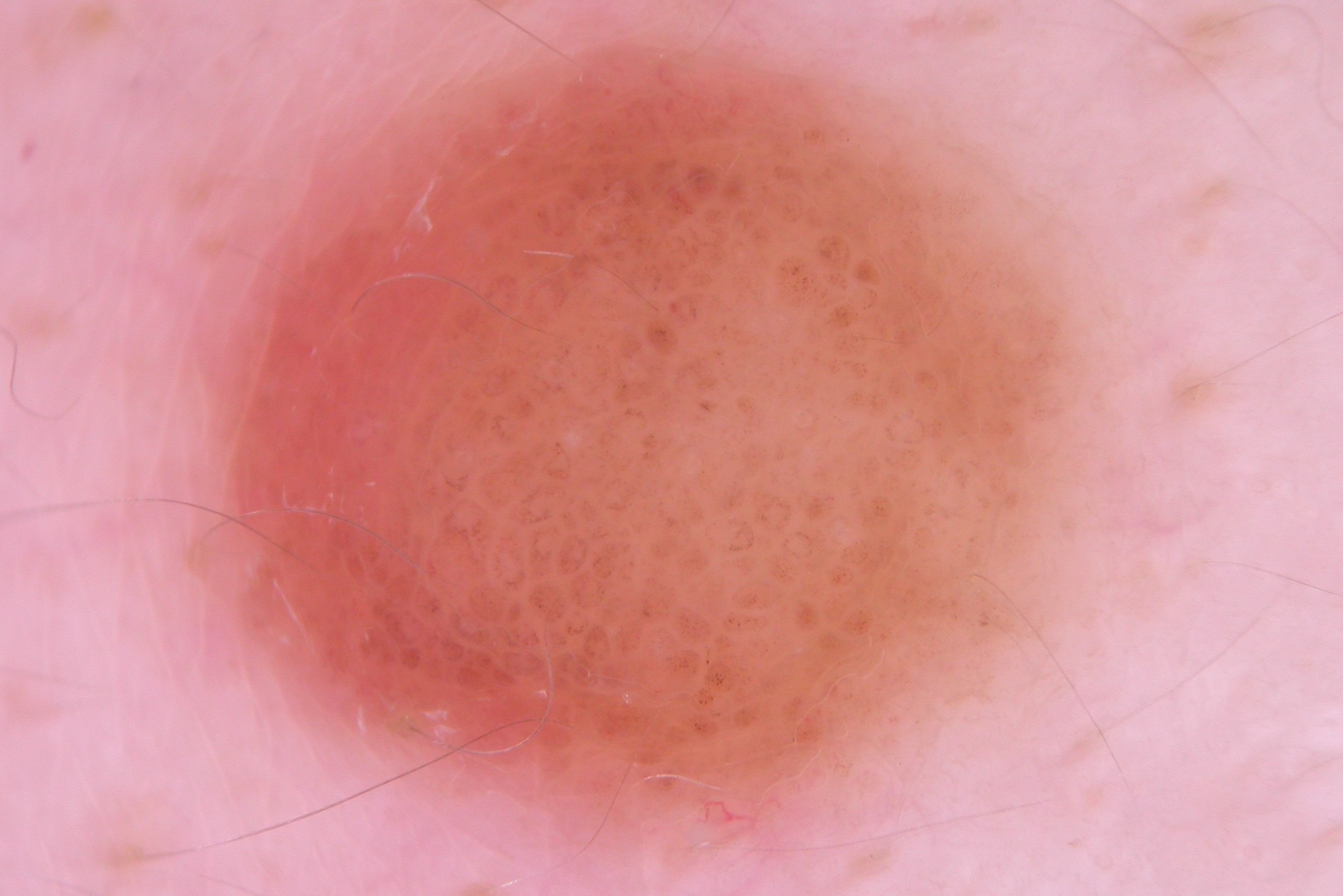 Nevus de Spitz amelanótico D20;  retículo negativo de distribución regular, sobre un fondo rosa homogéneo1