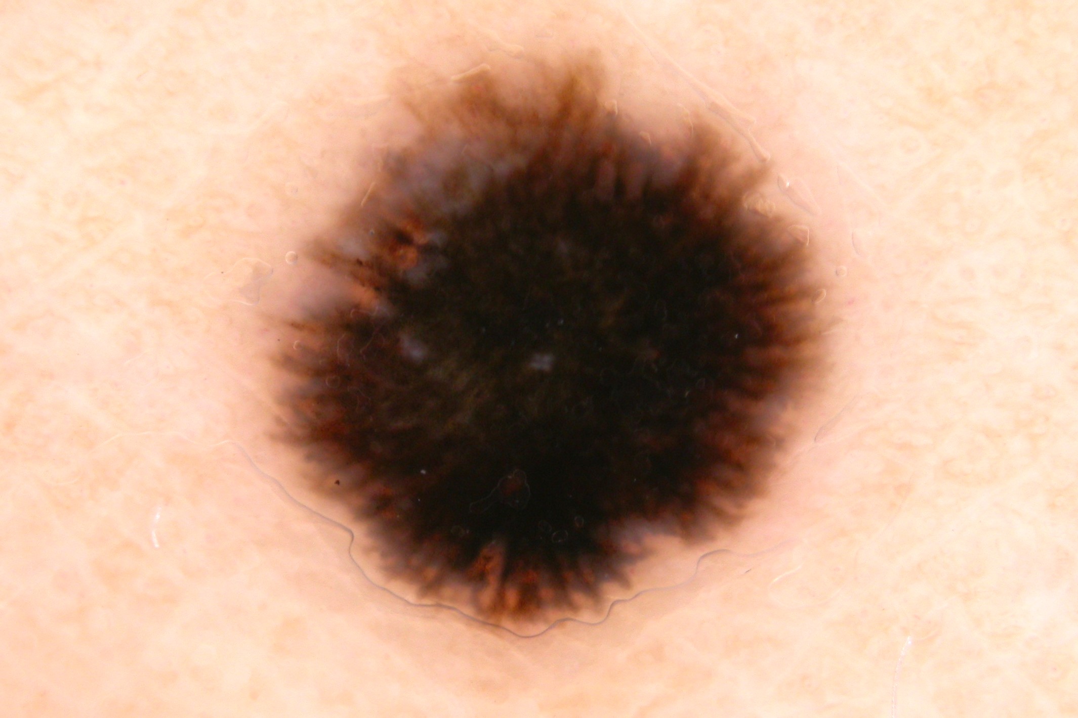 Nevus de Spitz, dermatoscopia; patron en estallido de estrellas (1)