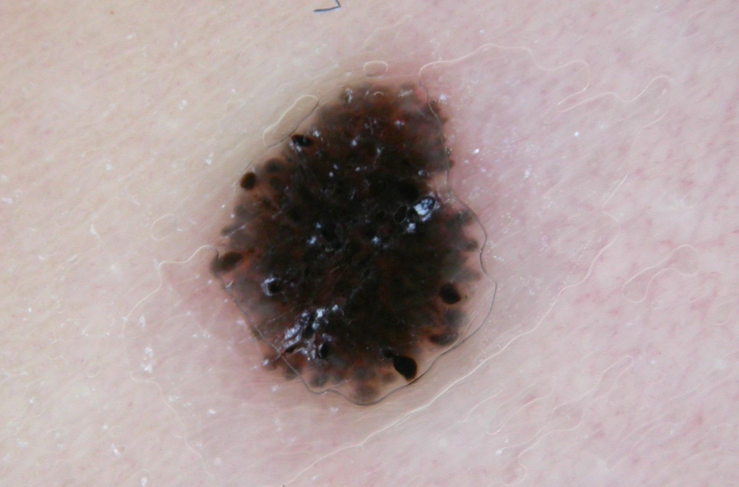 Nevus de Spitz, dermatoscopia; patron en estallido de estrellas (2)