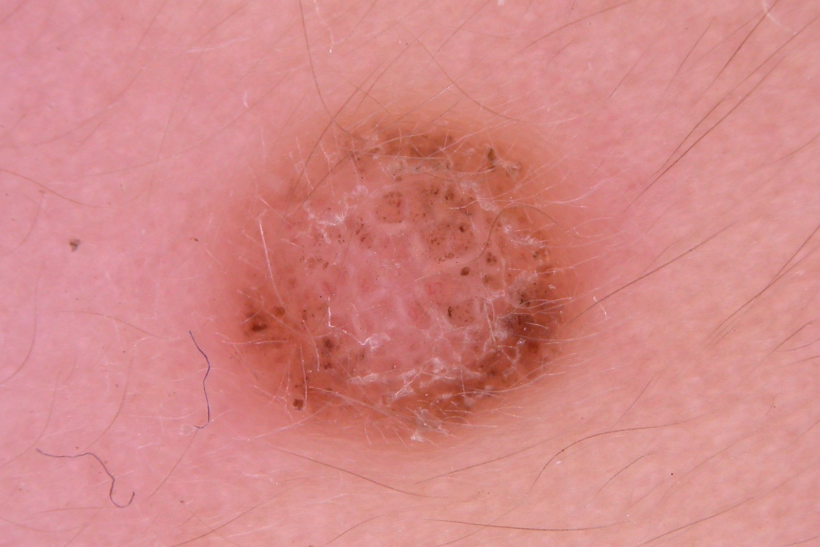 Nevus de Spitz hipomelanótico D20;  puntos y glo retículo negativo de distribución regular, vasos polimórficos