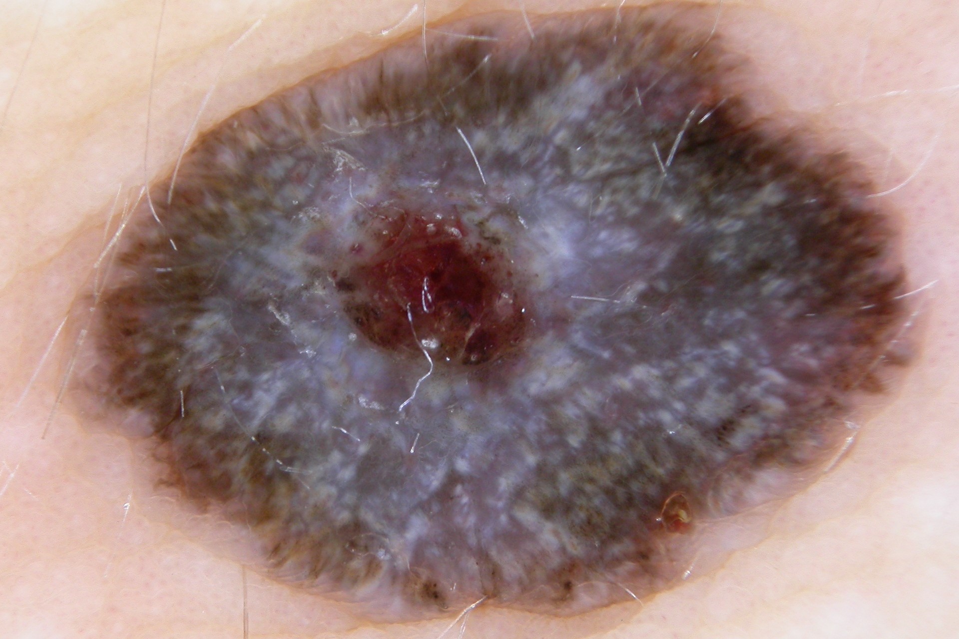 Nevus de Spitz pigmentado; líneas blancas o crisálidas sobre un patrón pigmentado homogéneo