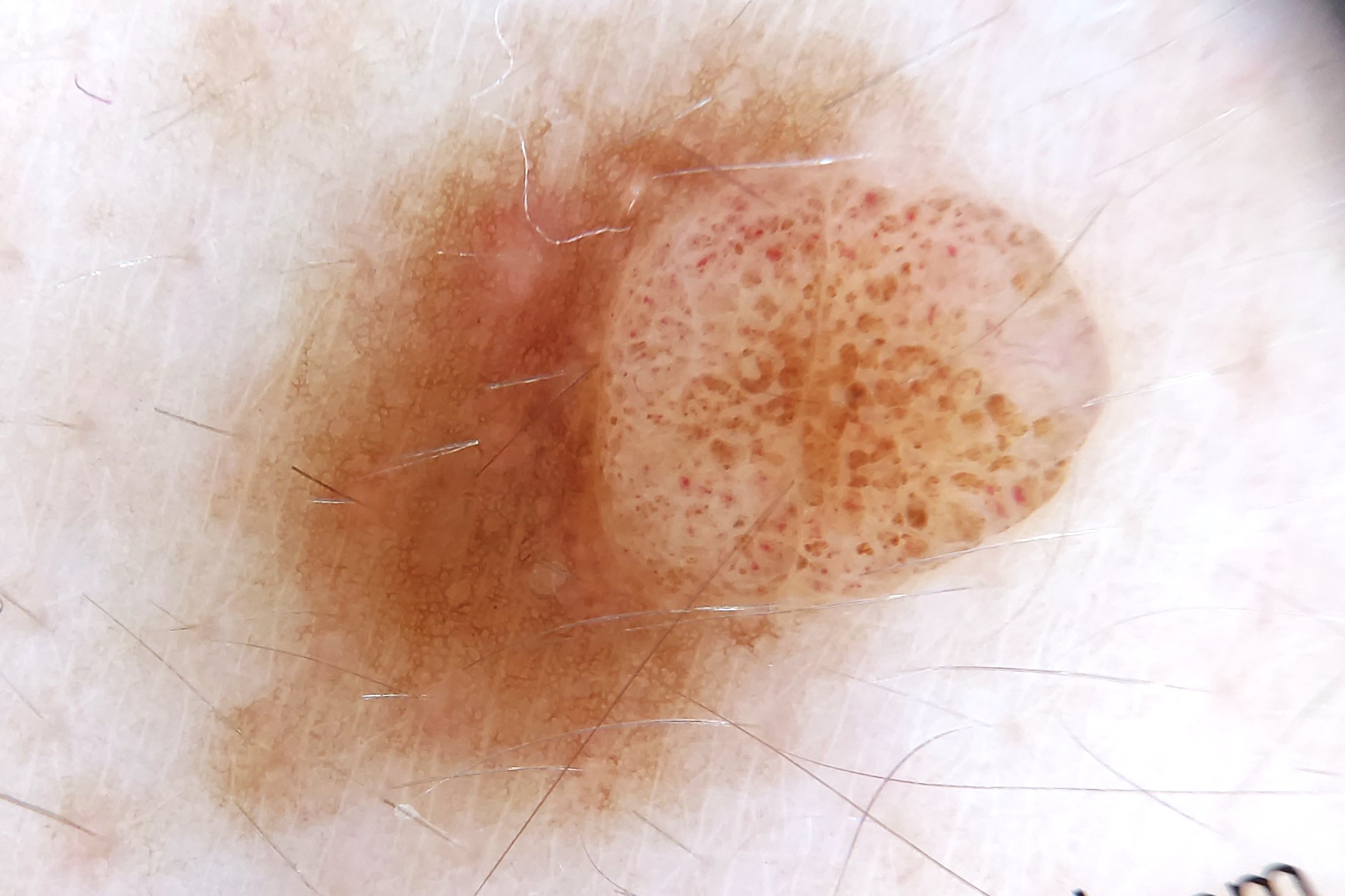Nevus melanocítico compuesto, dermatoscopia; patrón reticulo-globular, Retículo típico en la mitad izquierda y patrón globular en la derecha