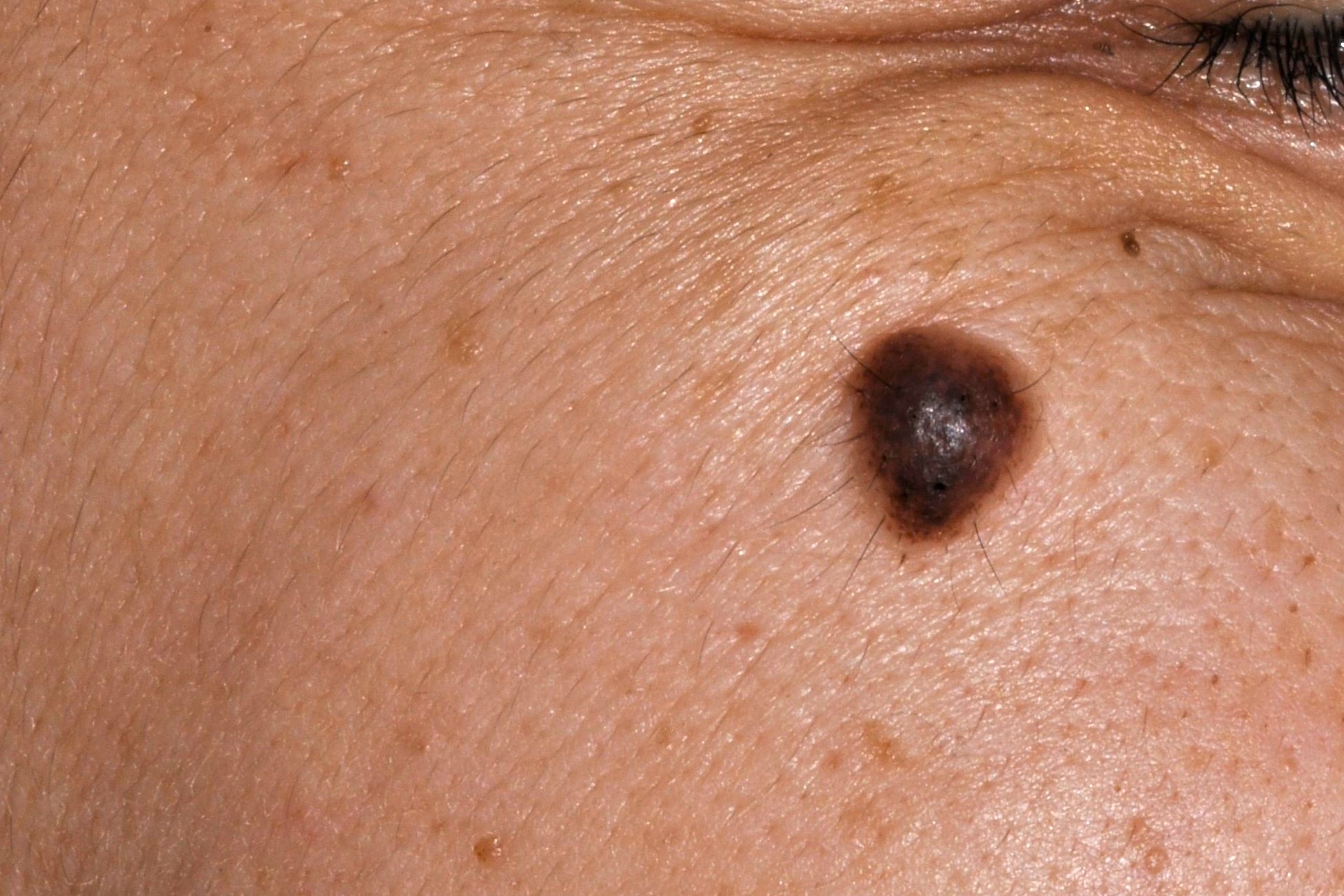 Nevus melanocitico común adquirido D22; pápula pigmentada, ovalada, semiesférica de color marron uniforme (1)