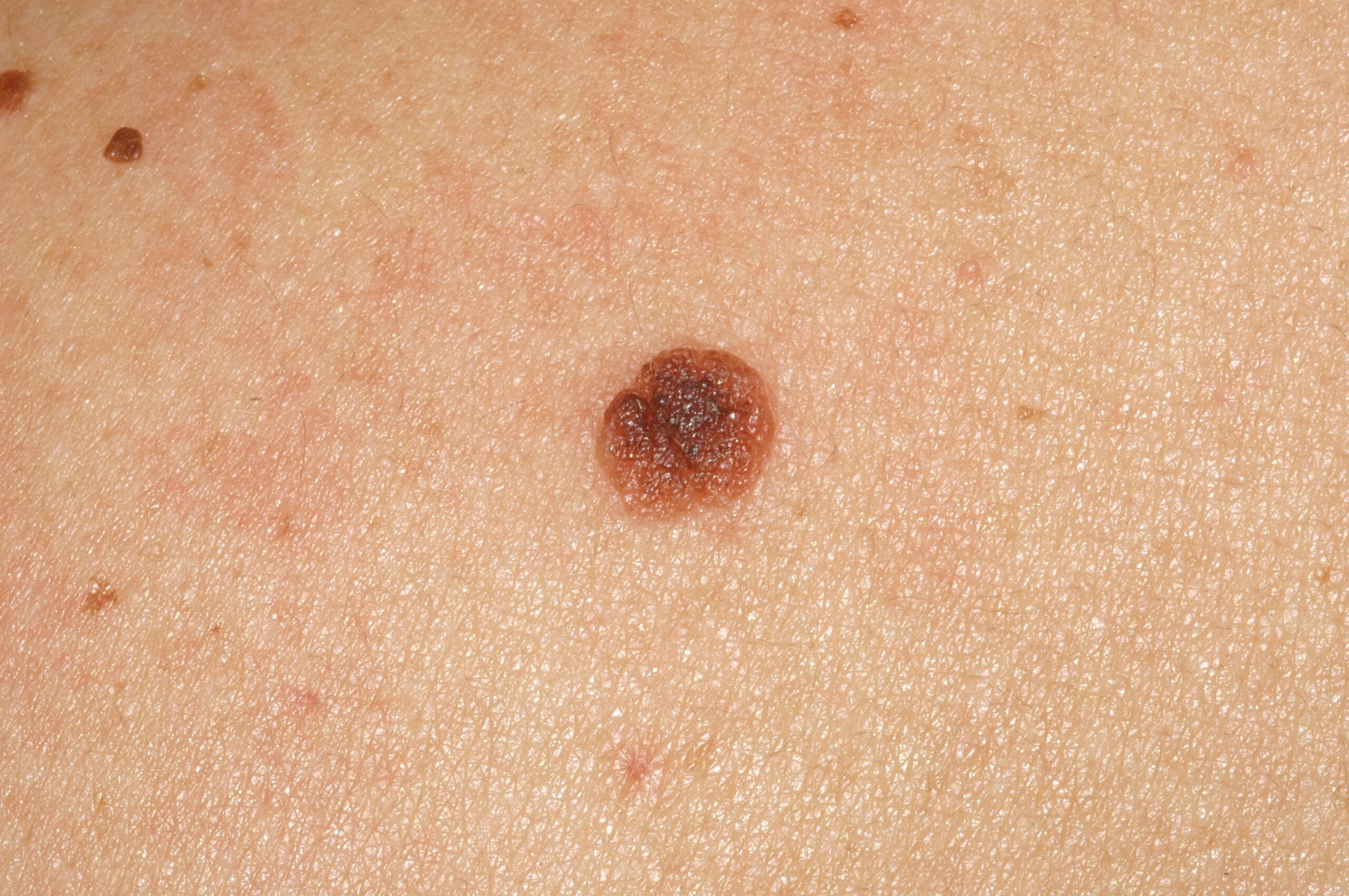 Nevus melanocitico común adquirido D22; pápula pigmentada, ovalada, semiesférica de color marron uniforme (4)