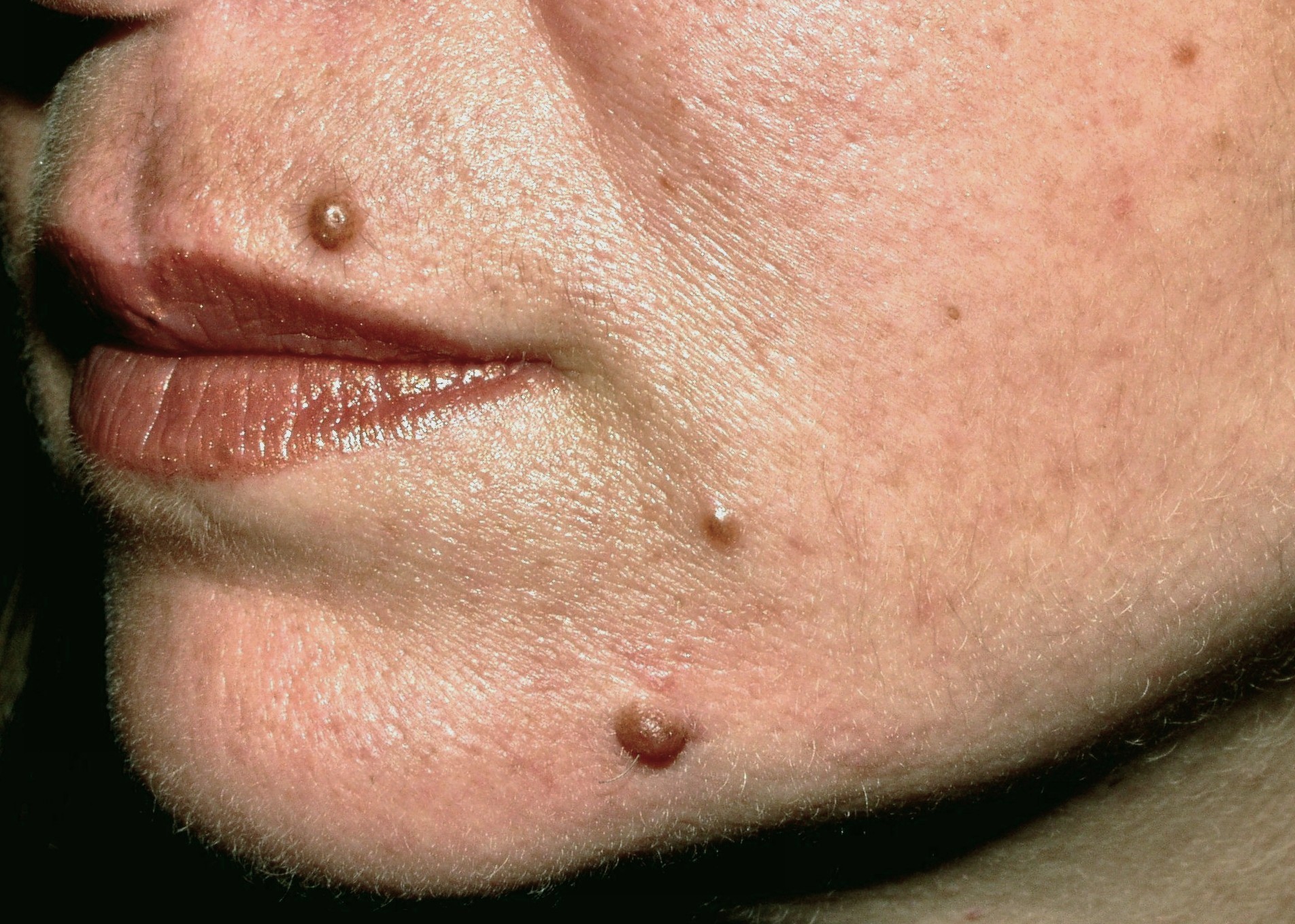 Nevus melanocitico común adquirido compuesto D22; pápula pigmentada, ovalada, semiesférica de color marron uniforme1