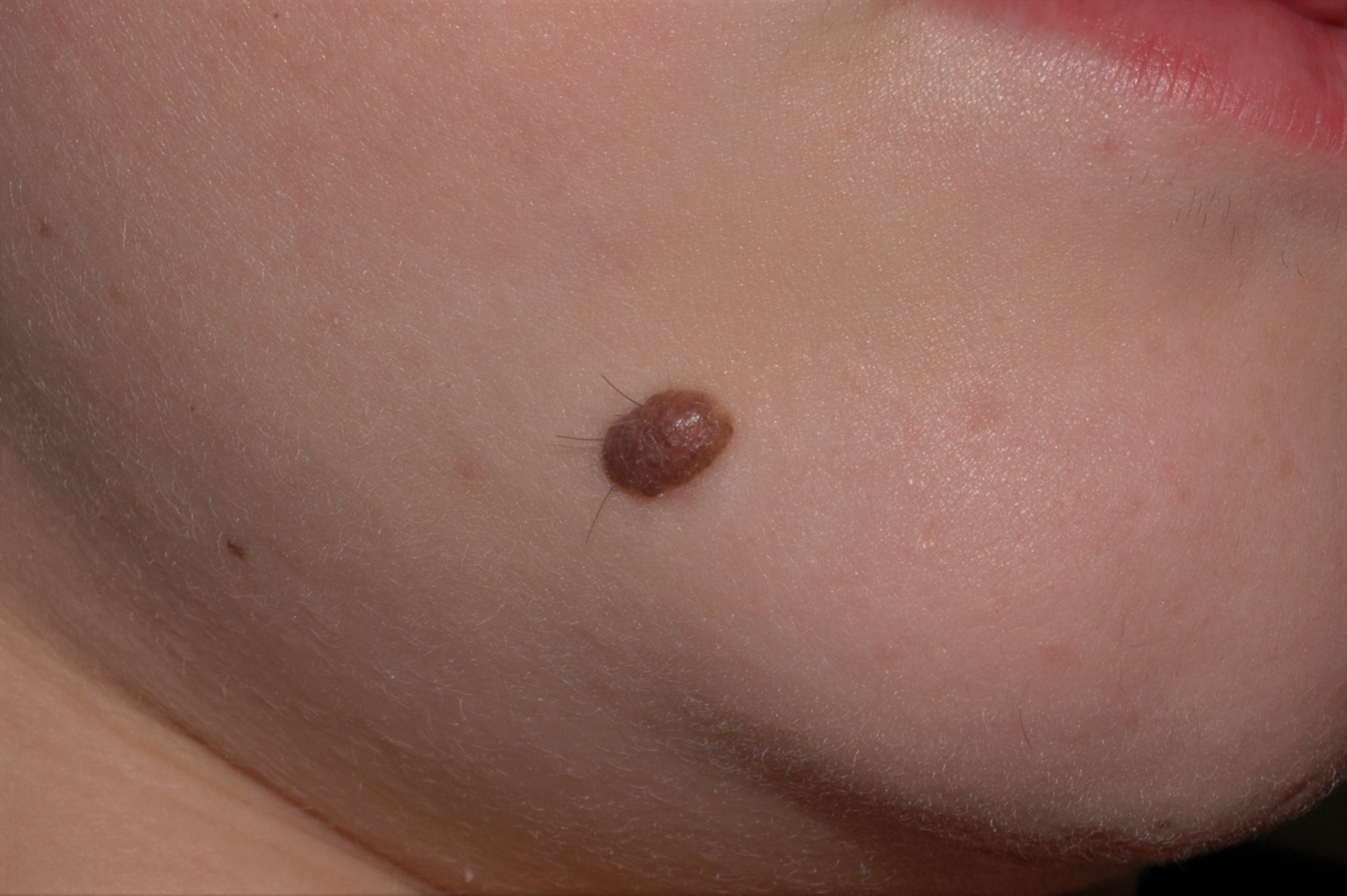 Nevus melanocitico común adquirido compuesto D22; pápula pigmentada, ovalada, semiesférica de color marron uniforme1 (1)