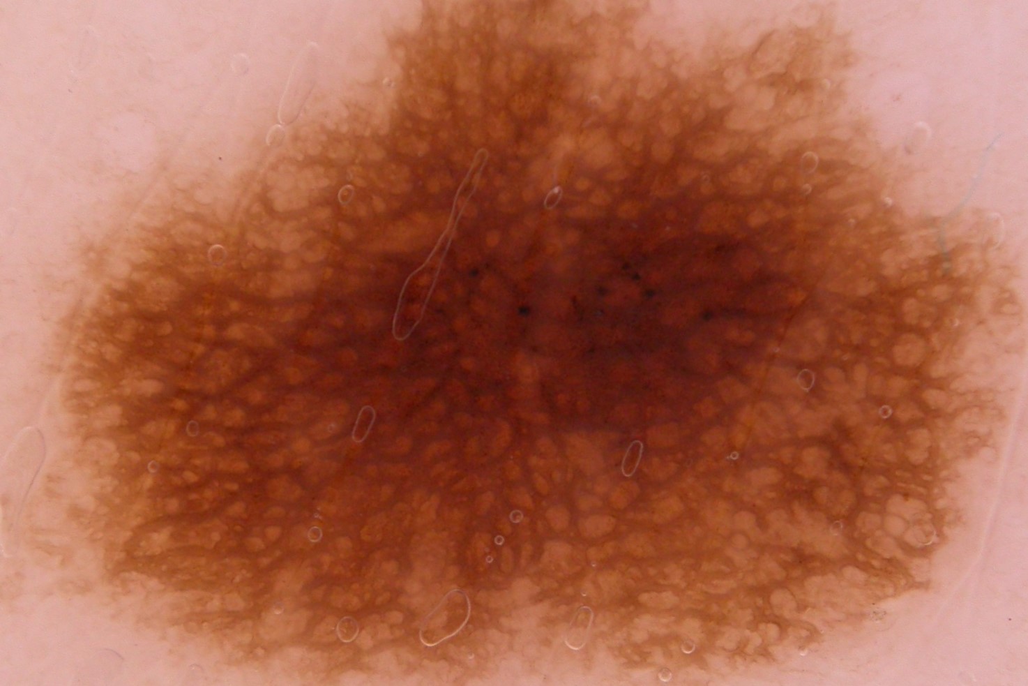 Nevus melanocitico común adquirido compuesto; dermatoscopia. Patron reticular periférico con hiperpigmentación central (1)