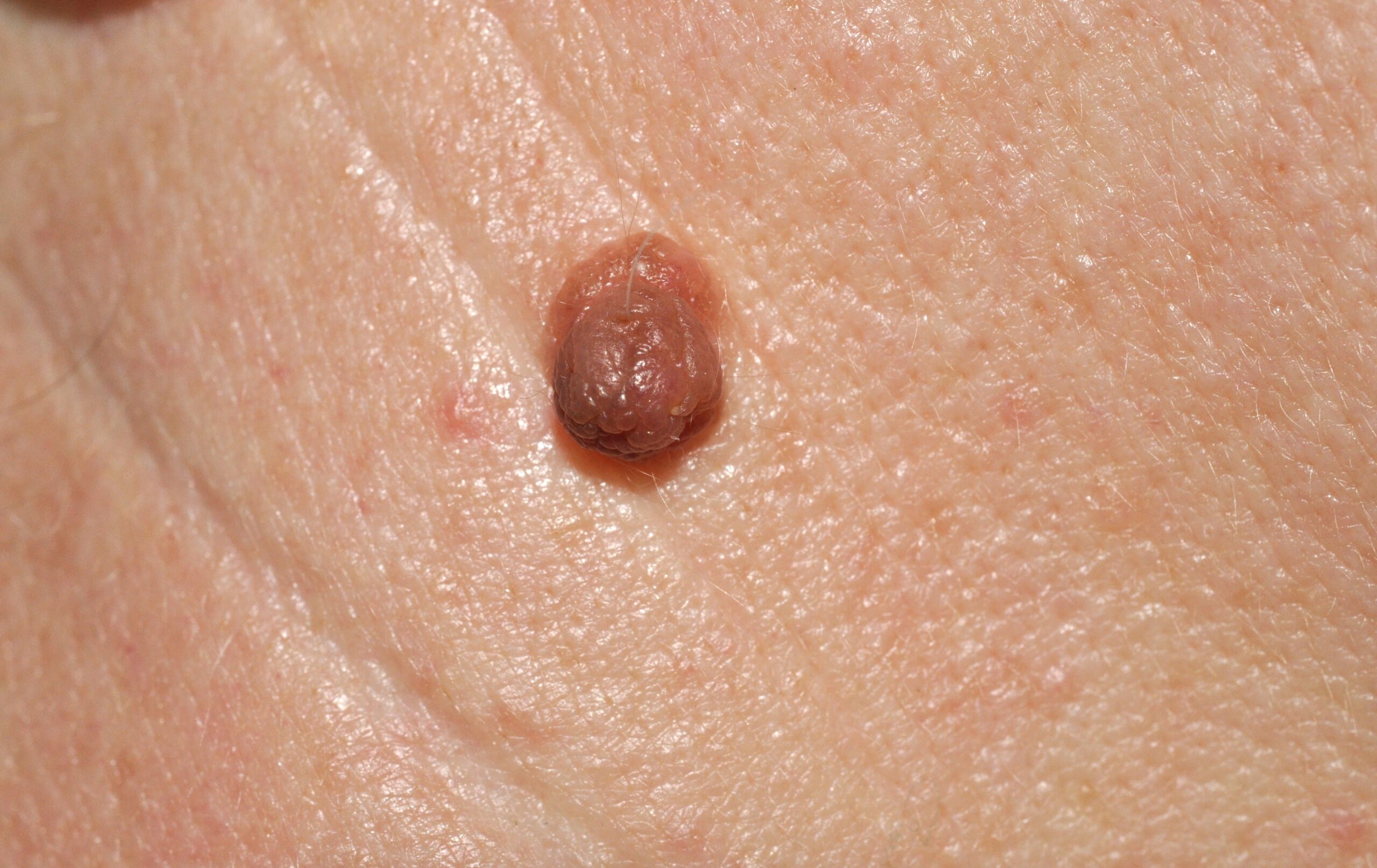 Nevus melanocitico común adquirido intradérmico D22; pápula del color de la piel, de consistencia elástica