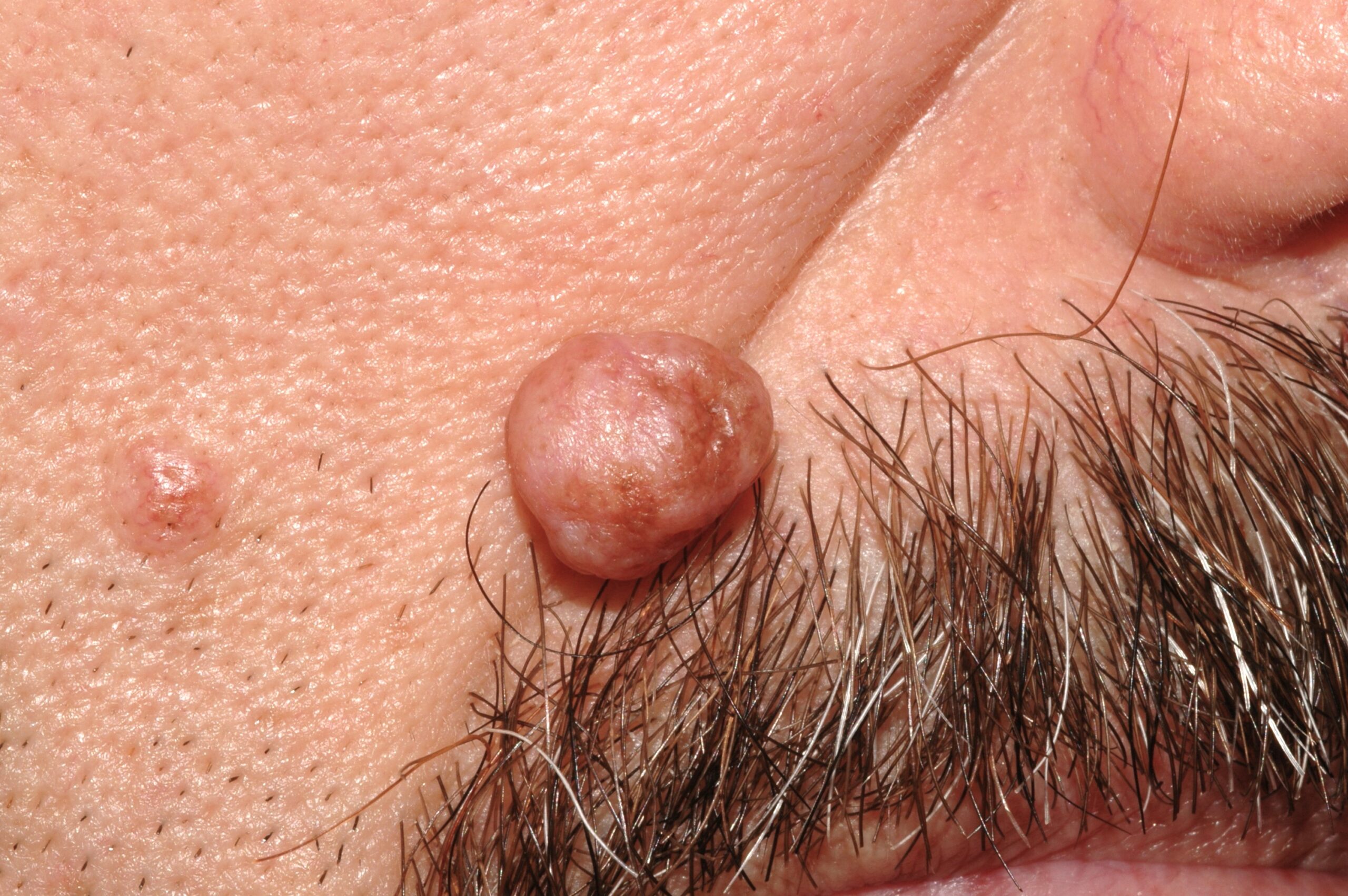 Nevus melanocitico común adquirido intradérmico D22; pápula del color de la piel, localizada en mentón desde hace