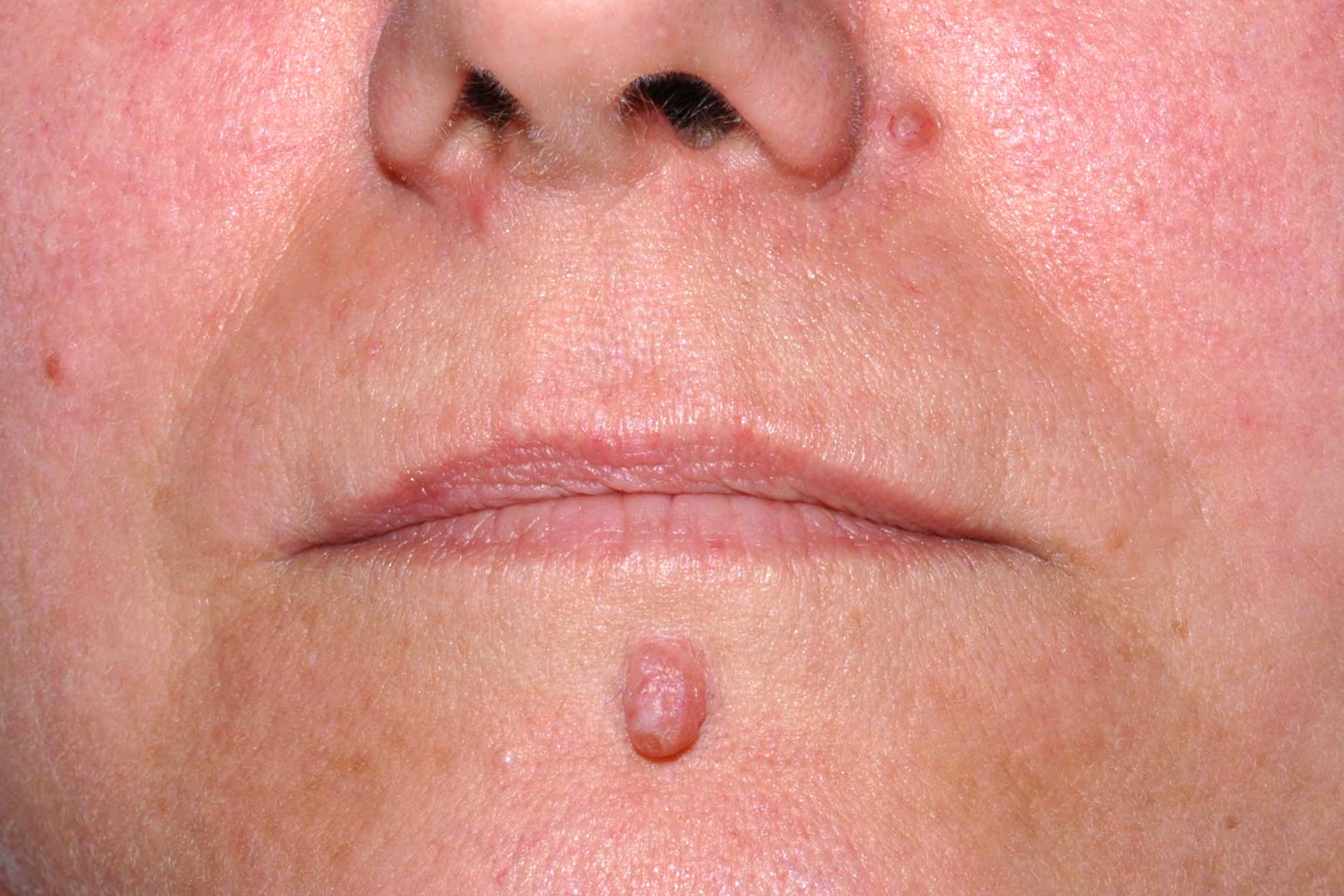 Nevus melanocitico común adquirido intradérmico D22; pápula del color de la piel, localizada en mentón desde hace años (1)