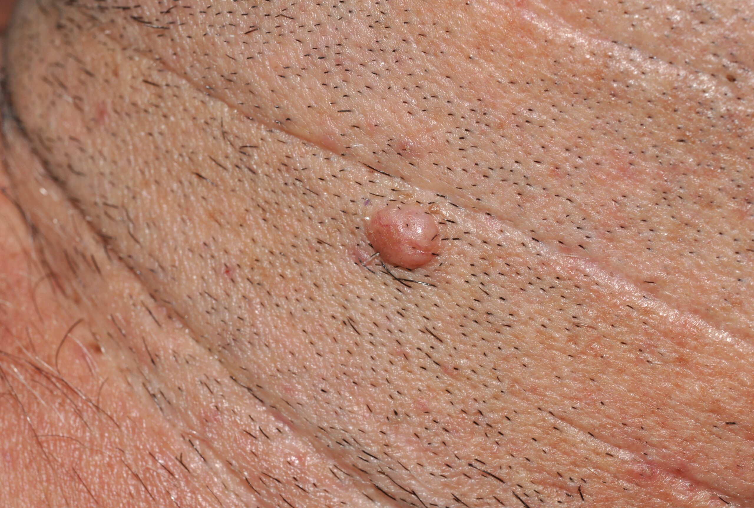 Nevus melanocitico común adquirido intradérmico D22; pápula del color de la piel, localizada sobre el ángulo mandibular